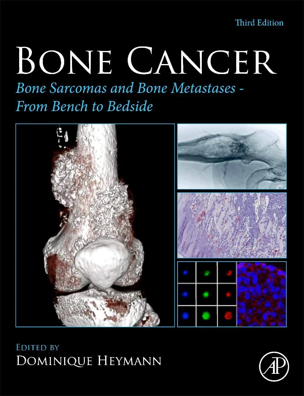 Coperta cărții "Bone Cancer" de Dominique Heymann
