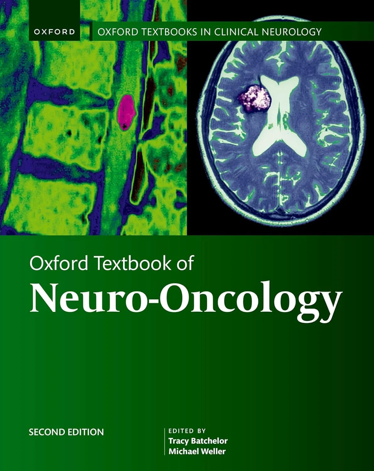 Oxford Textbook of Neuro-Oncology, Second Edition