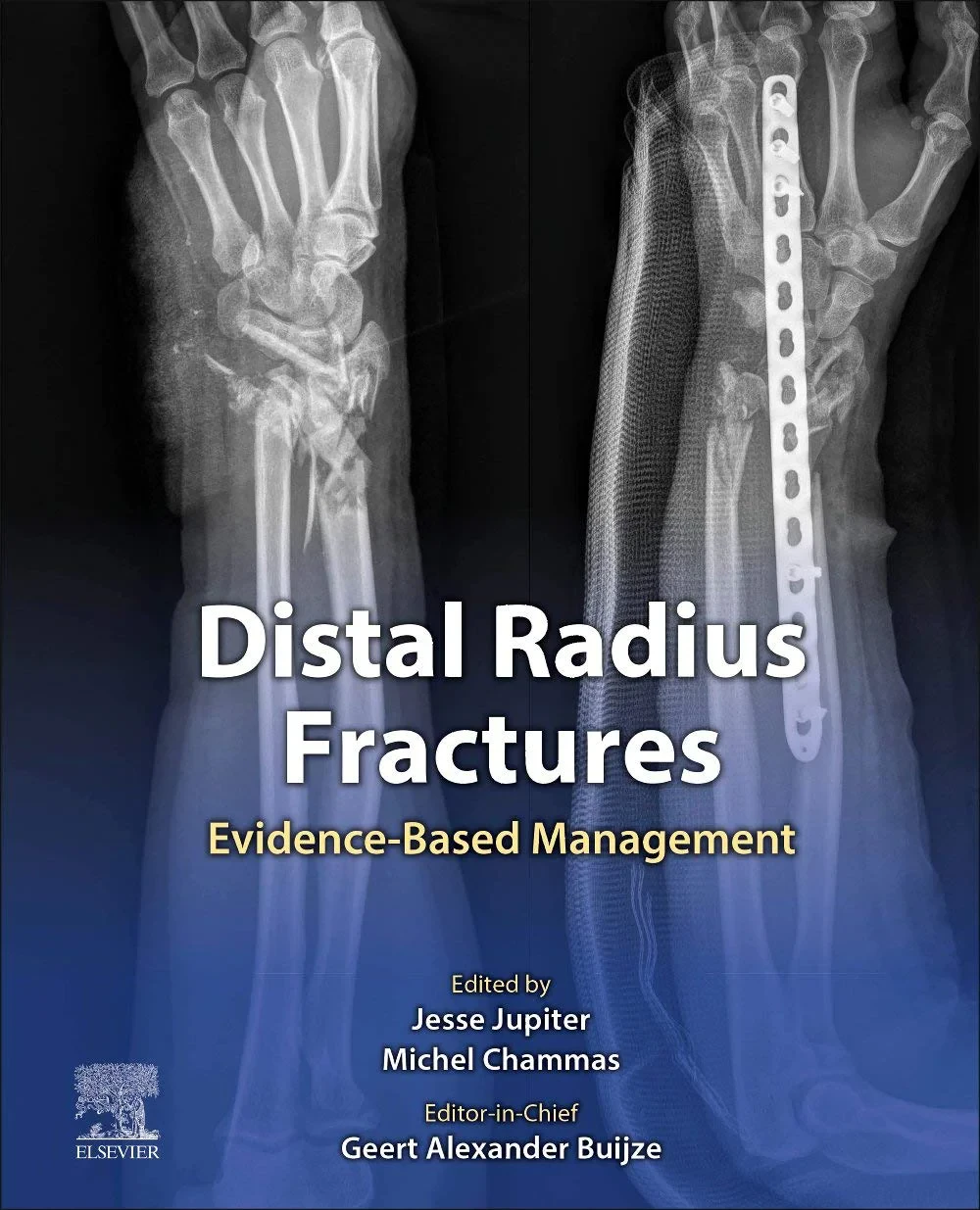 Coperta cărții "Distal Radius Fractures: Evidence-Based Management" de Geert Alexander Buijze MD PhD Hand Surgeon, Jesse Jupiter MD, Michel Chammas MD PhD