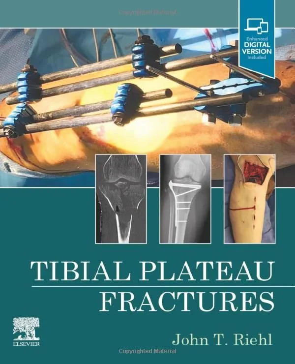 Coperta cărții "Tibial Plateau Fractures " de John Riehl