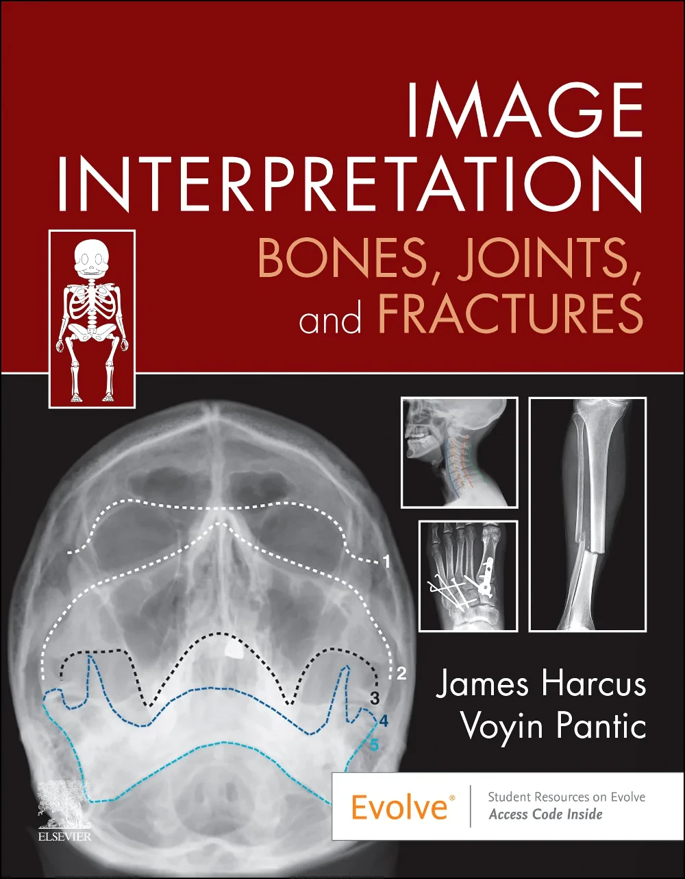 Coperta cărții "Image Interpretation: Bones, Joints, and Fractures, 1st Edition" de James Harcus &amp; Voyin Pantic