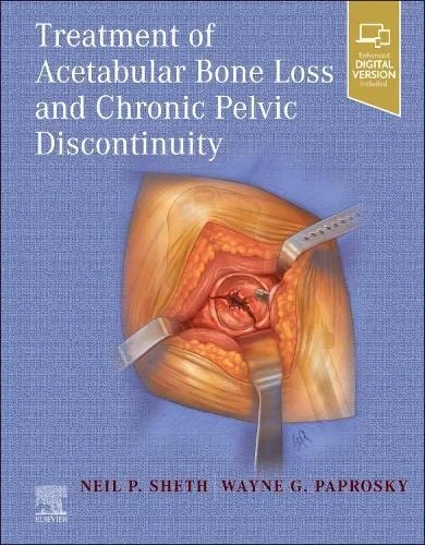 Coperta cărții "Treatment of Acetabular Bone Loss and Chronic Pelvic Discontinuity" de Neil P. Sheth MD FACS, Wayne Paprosky MD FACS