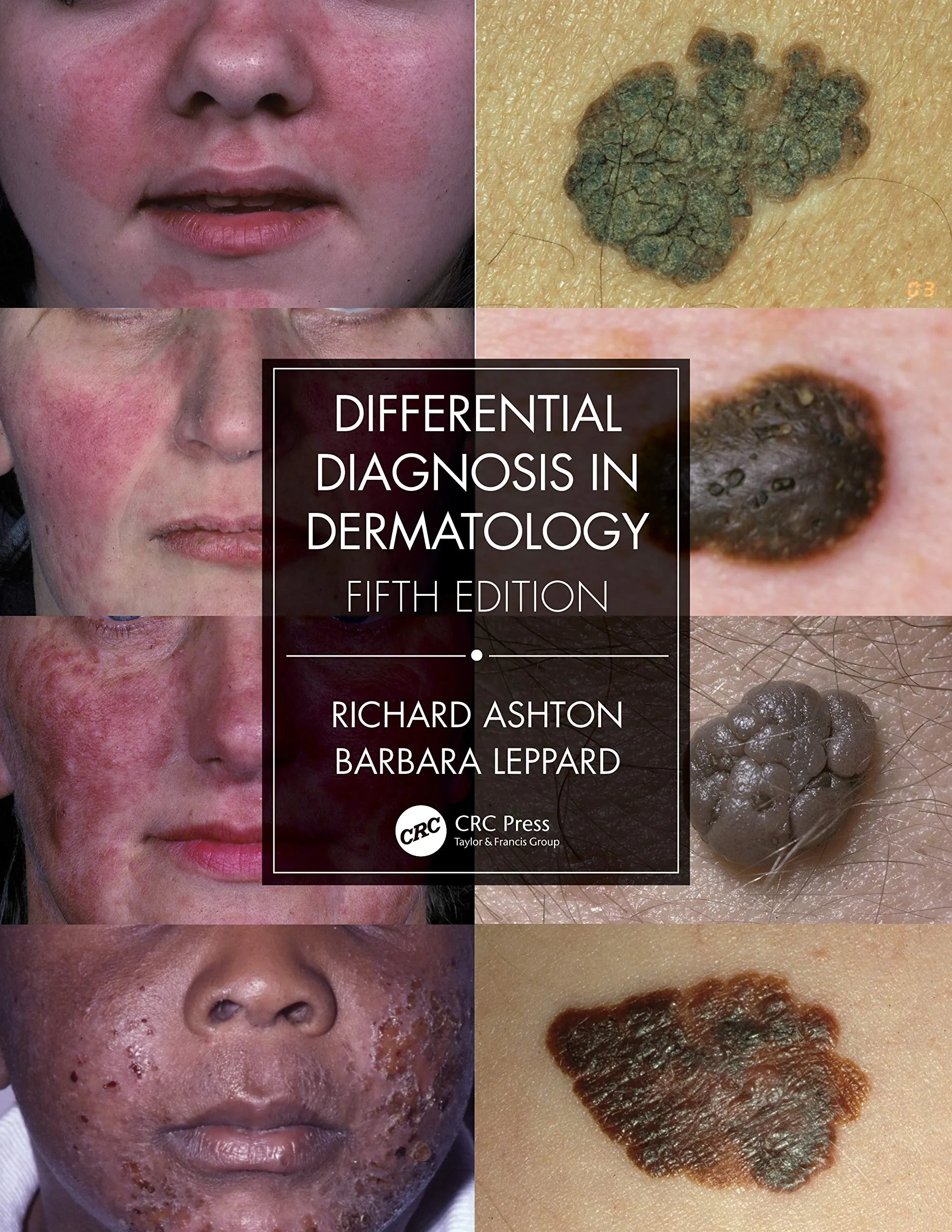 Coperta cărții "Differential Diagnosis in Dermatology" de Richard Ashton (