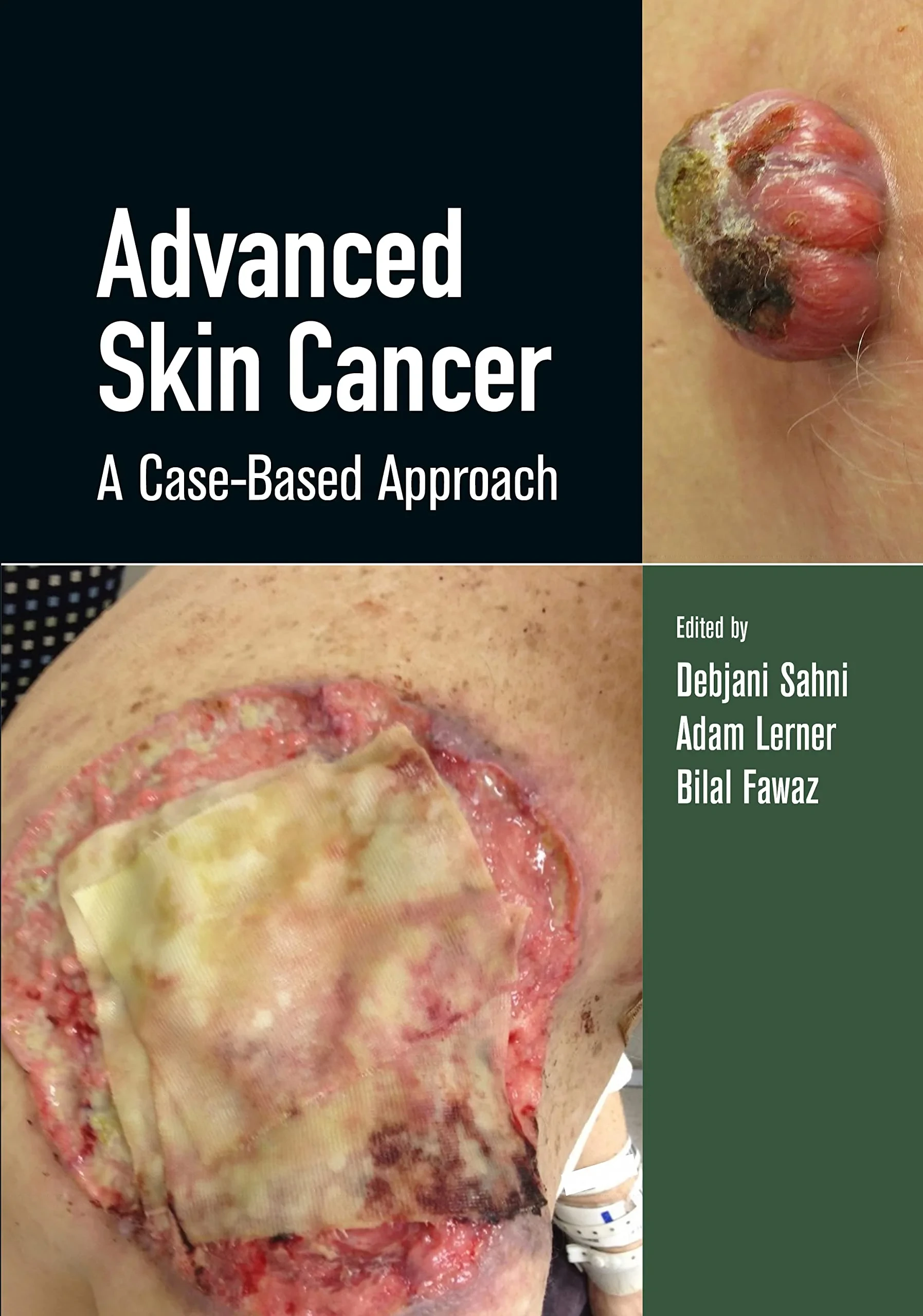 Coperta cărții "Advanced Skin Cancer: A Case-Based Approach" de Debjani Sahni, Adam Lerner, Bilal Fawaz