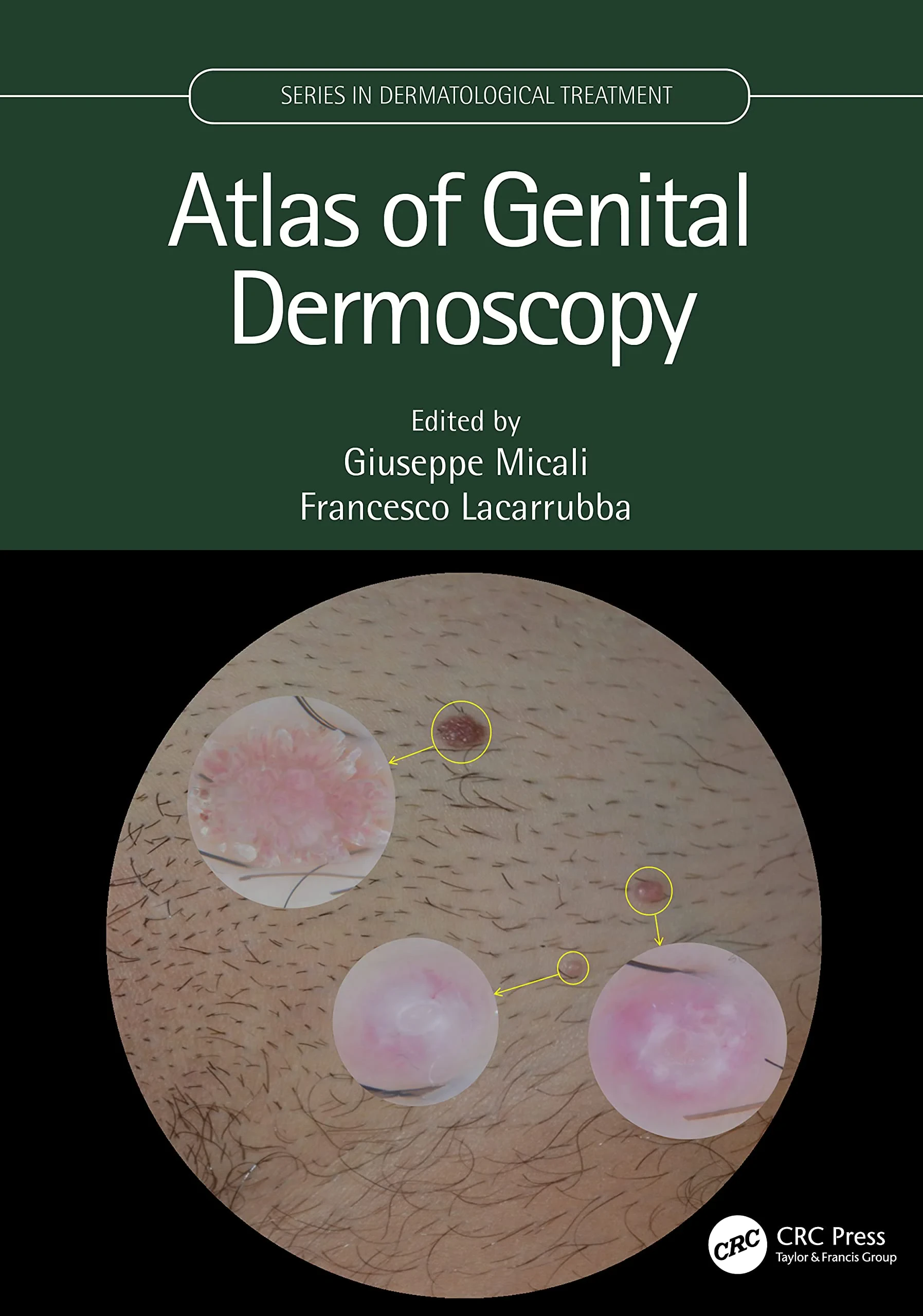 Coperta cărții "Atlas of Genital Dermoscopy" de Giuseppe Micali, Francesco Lacarrubba