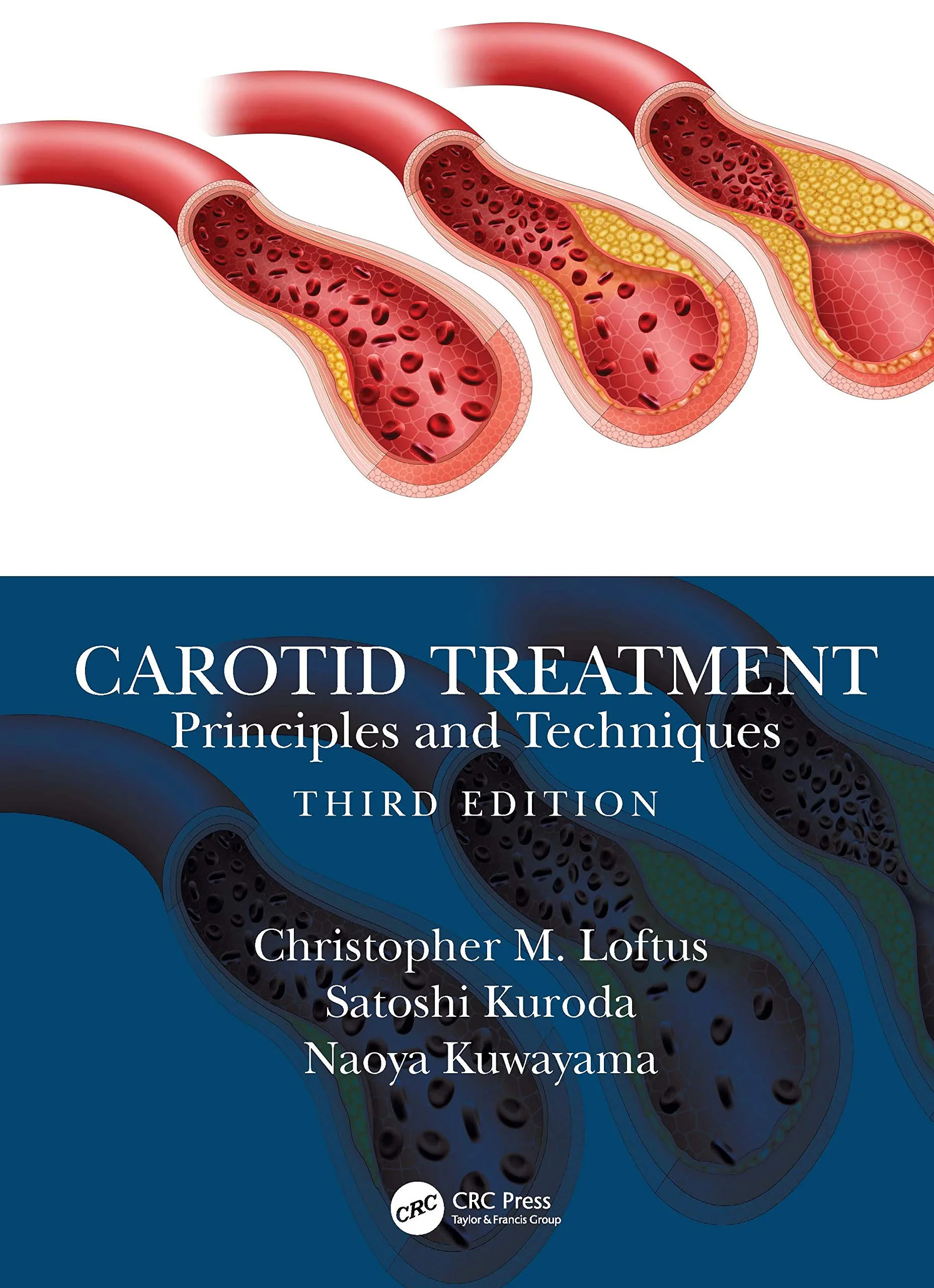 Coperta cărții "Carotid Treatment: Principles and Techniques" de Satoshi Kuroda, Naoya Kuwayama, Christopher Miranda Loftus