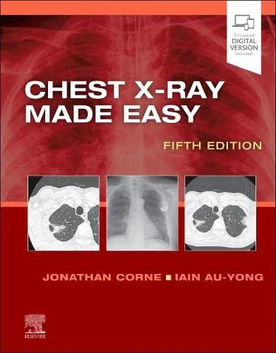 Coperta cărții "Chest X-Ray Made Easy" de Jonathan Corne MA PhD MB BS FRCP, Iain Au-Yong MA BMBCh MRCS FRCR
