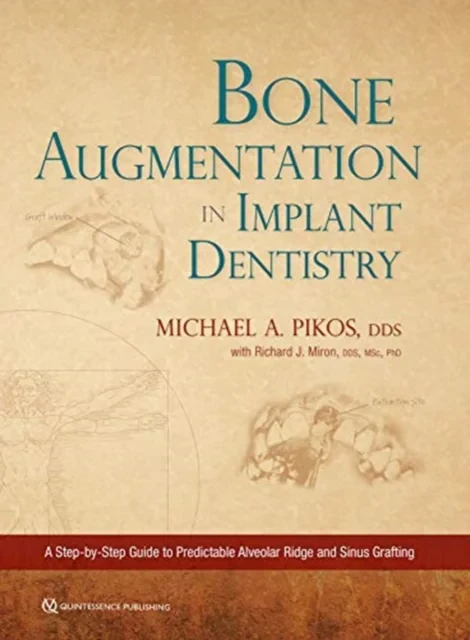 Bone Augmentation in Implant Dentistry: A Step-by-...