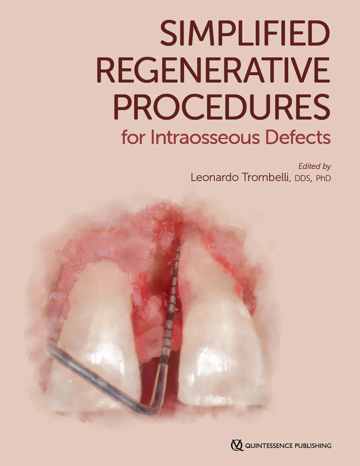 Coperta cărții "Simplified Regenerative Procedures for Intraosseous Defects" de Trombelli, Leonardo