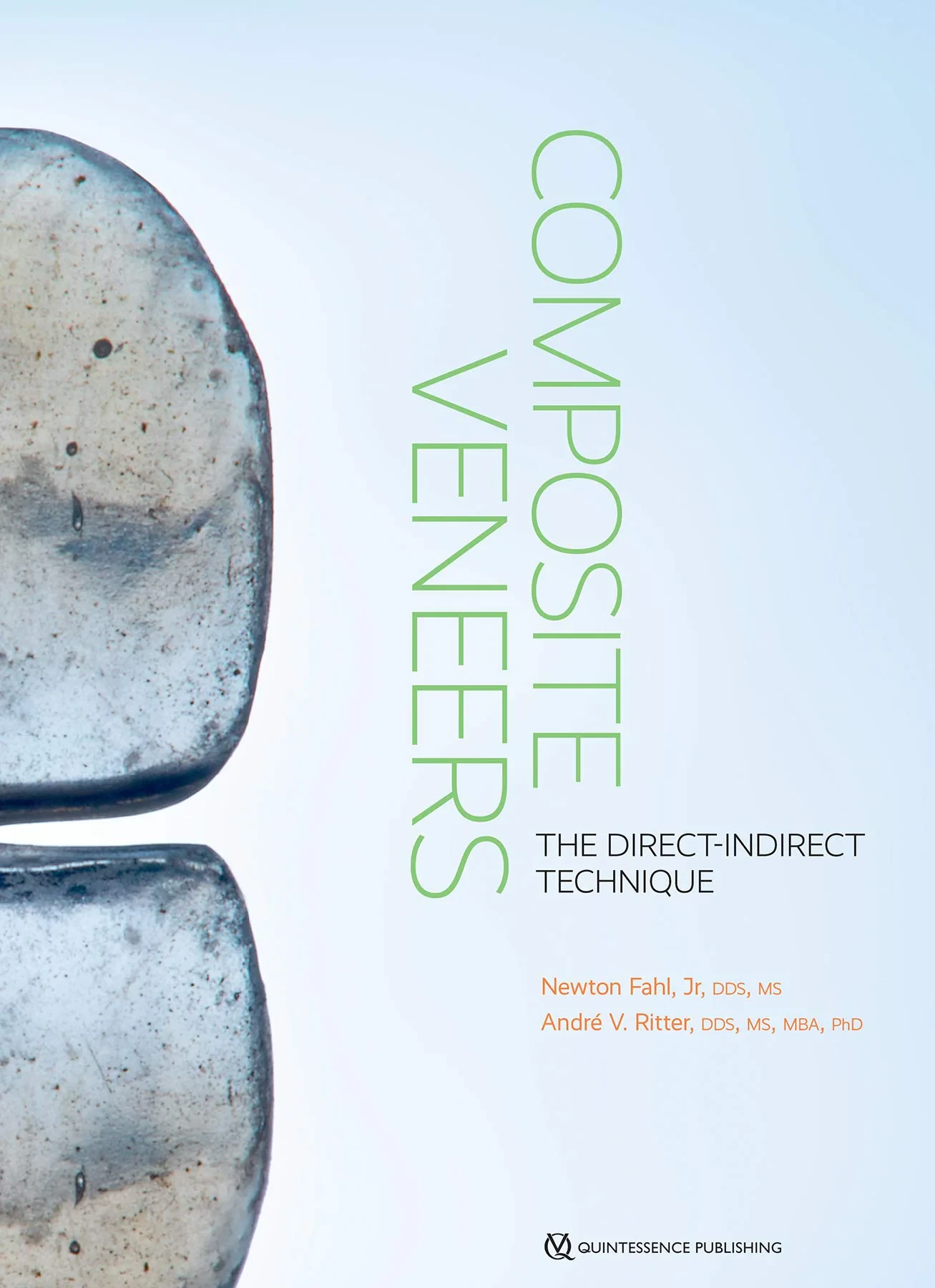 Composite Veneers: The Direct-Indirect Technique