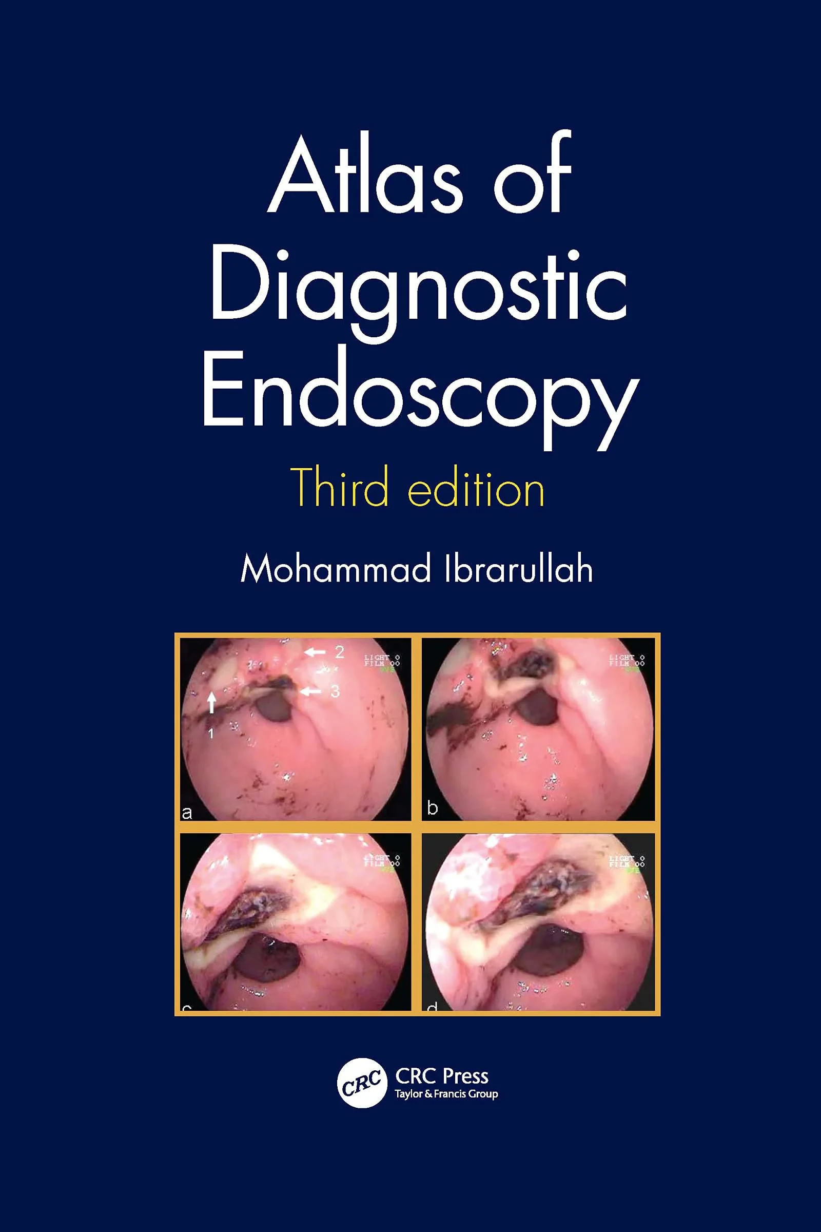 Coperta cărții "Atlas of Diagnostic Endoscopy, 3E" de Mohammad Ibrarullah