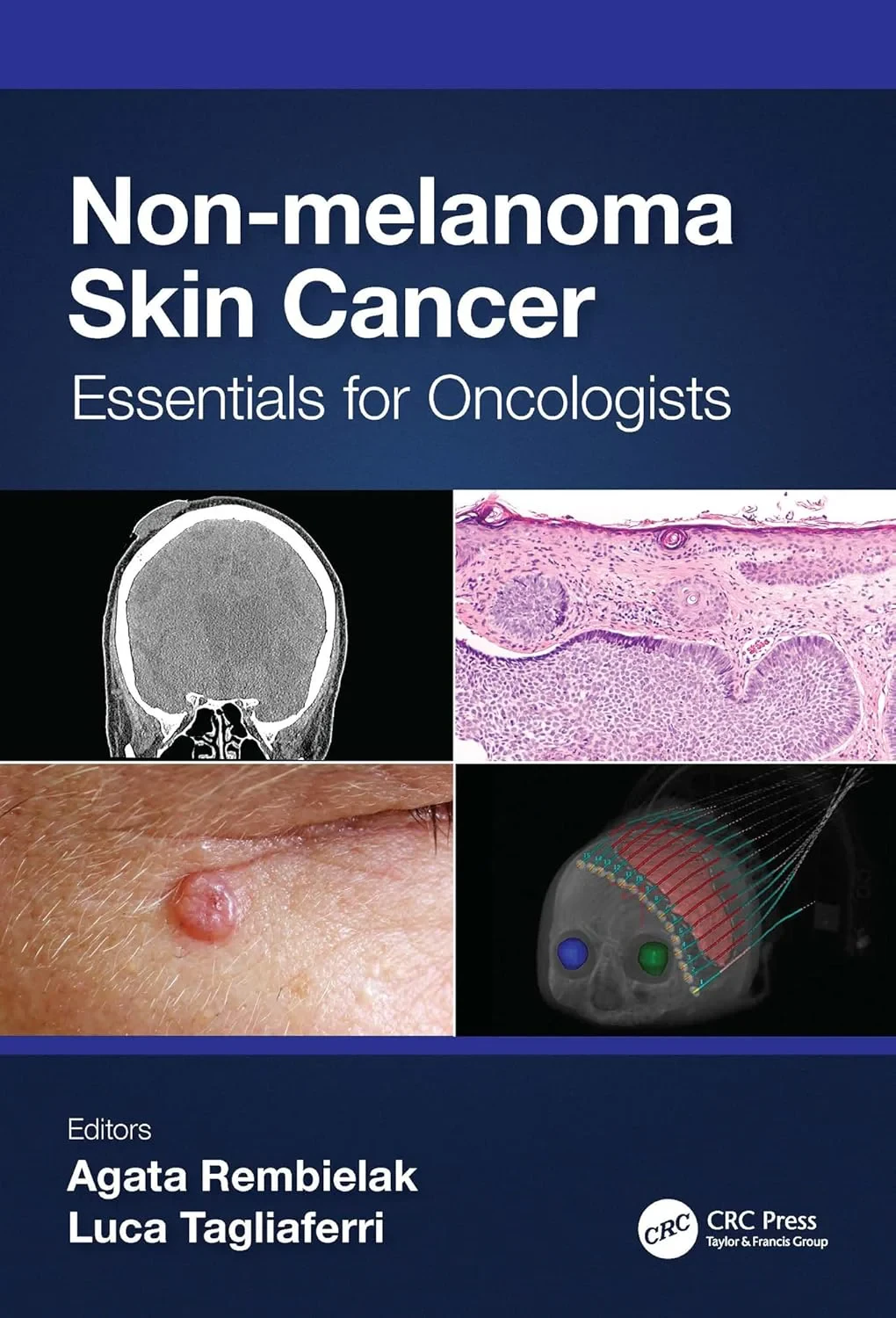 Coperta cărții "Non-melanoma Skin Cancer. Essentials for Oncologists" de Agata Rembielak, Luca Tagliaferri