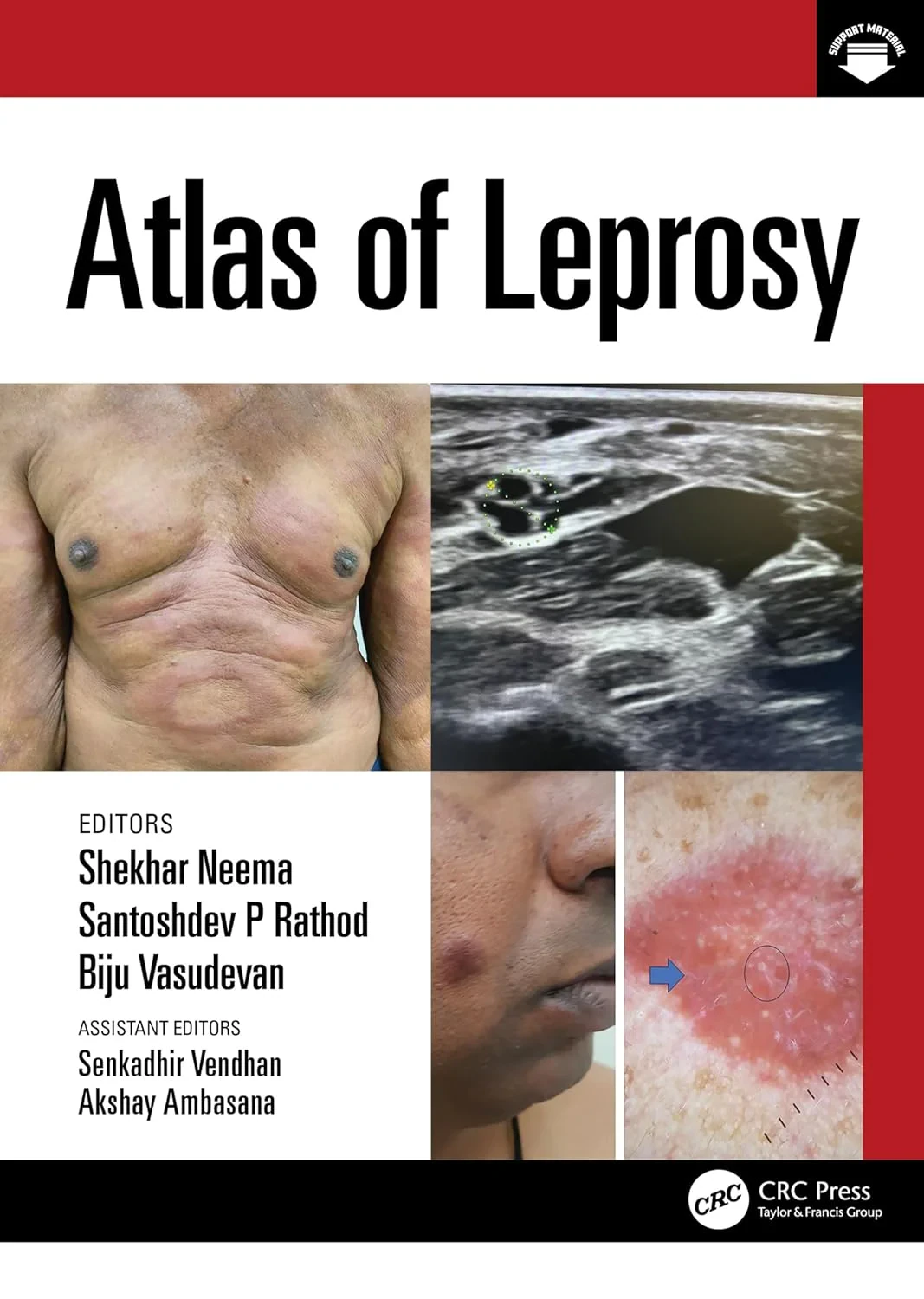 Coperta cărții "Atlas of Leprosy" de Biju Vasudevan, Santoshdev Rathod, Shekhar Neema