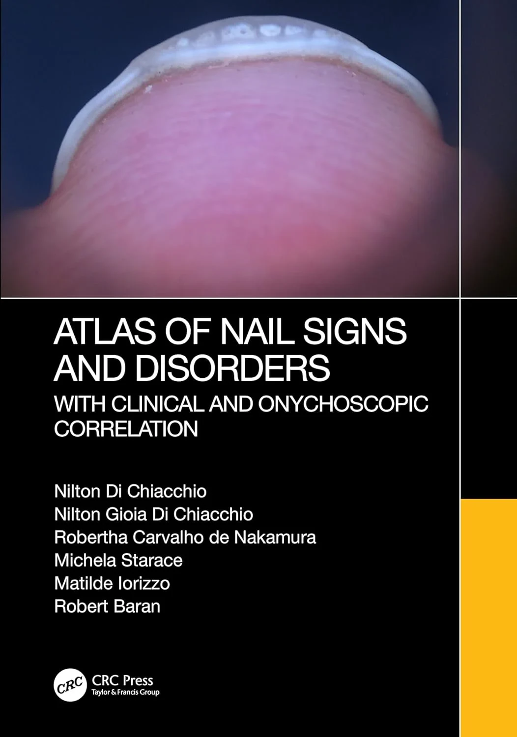 Coperta cărții "Atlas of Nail Signs and Disorders with Clinical and Onychoscopic Correlation" de Robert Baran, Nilton Di Chiacchio, Nilton Gioia Di Chiacchio, Robertha Carvalho de Nakamura, Michela Starace, Matilde Iorizzo