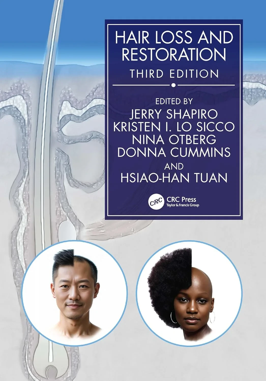 Coperta cărții "Hair Loss and Restoration" de Jerry Shapiro, Nina Otberg, Kristen Lo Sicco, Donna Cummins, Hsiao-Han Tuan
