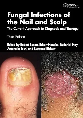Coperta cărții "Fungal Infections of the Nail and Scalp: The Current Approach to Diagnosis and Therapy" de Robert Baran, Eckart Haneke, Antonella Tosti, Roderick Hay, Bertrand Richert-Baran