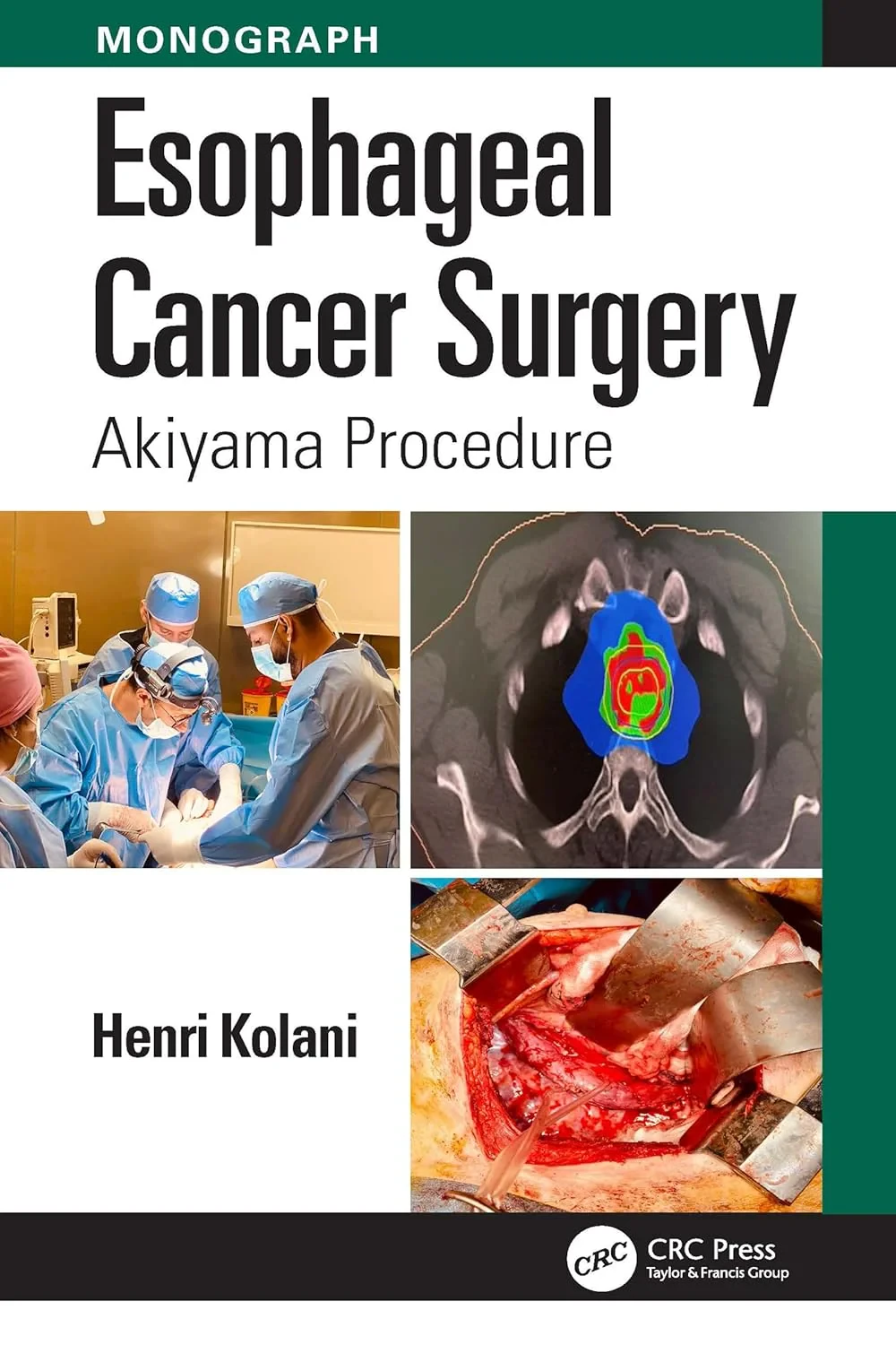 Coperta cărții "Esophageal Cancer Surgery: Akiyama Procedure" de Henri Kolani