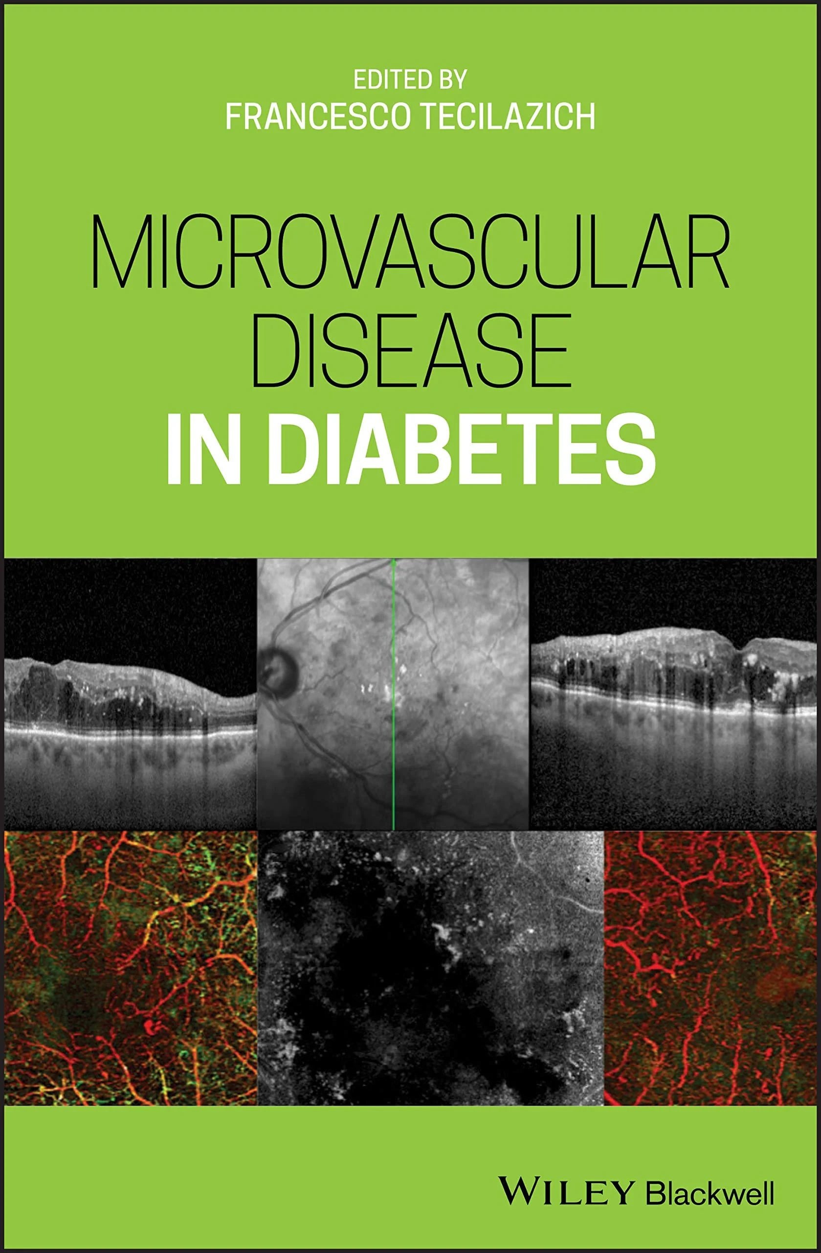 Coperta cărții "Microvascular Disease in Diabetes" de Francesco Tecilazich