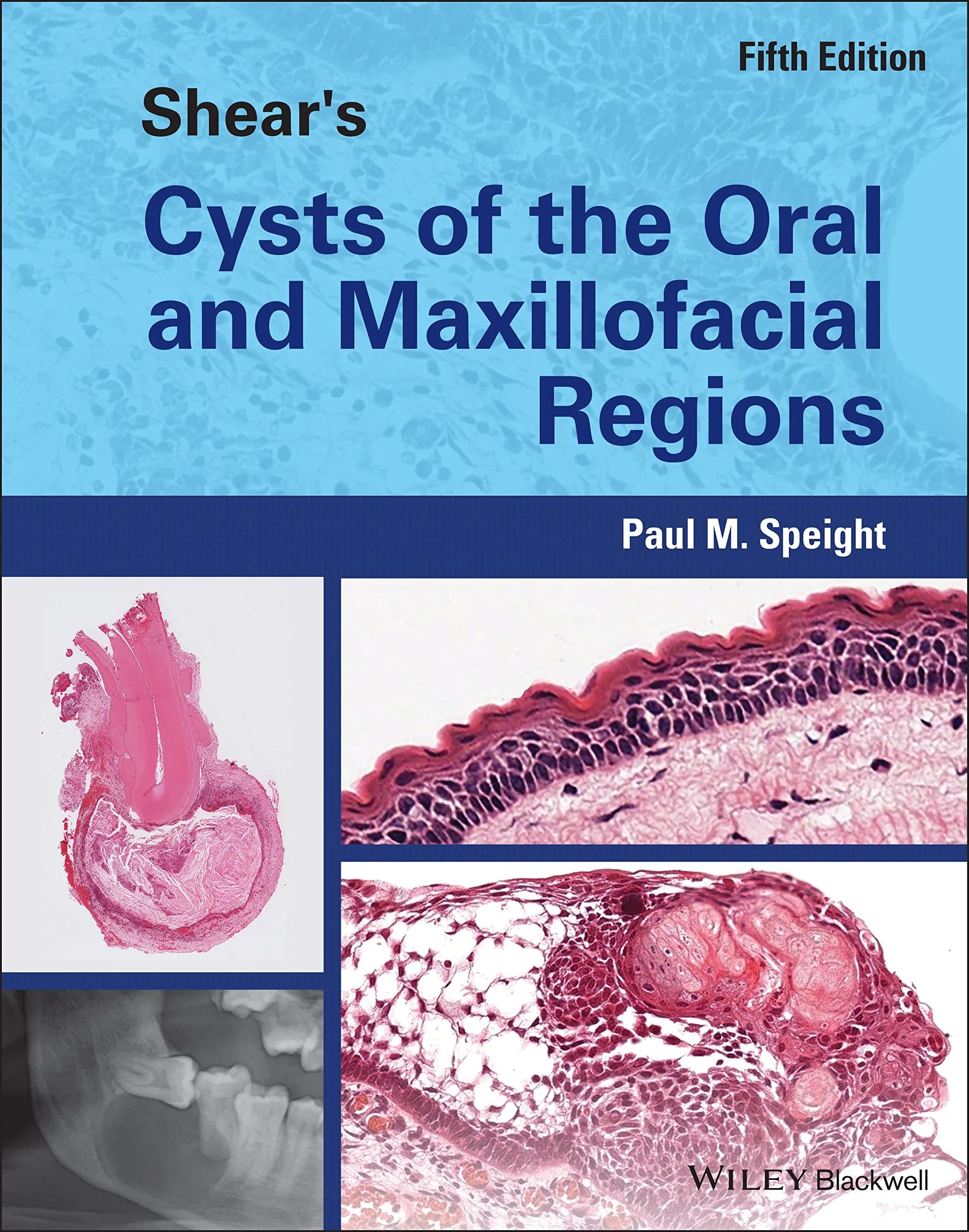 Coperta cărții "Shear′s Cysts of the Oral and Maxillofacial Region s 5th Edition" de Paul M. Speight