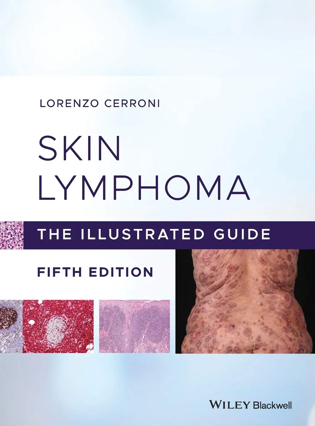 Coperta cărții "Skin Lymphoma: The Illustrated Guide" de Lorenzo Cerroni