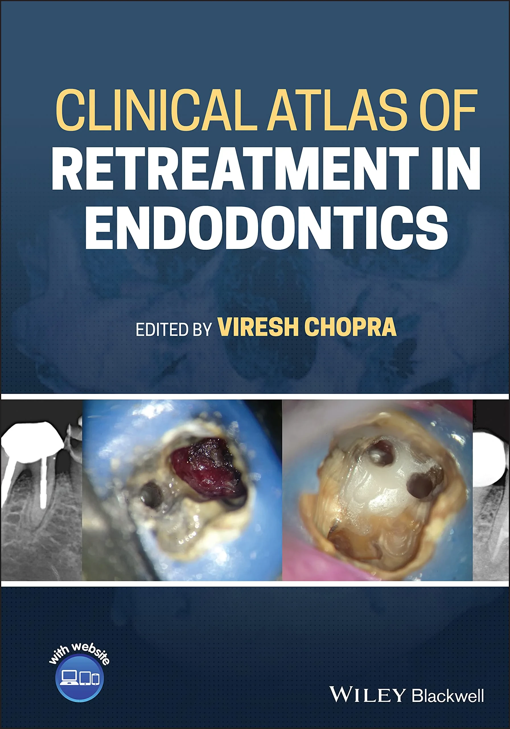 Coperta cărții "Clinical Atlas of Retreatment in Endodontics" de Viresh Chopra
