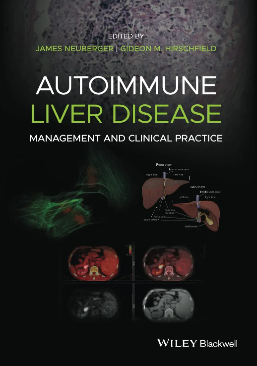 Coperta cărții "Autoimmune Liver Disease: Management and Clinical Practice" de James Neuberger, Gideon M. Hirschfield
