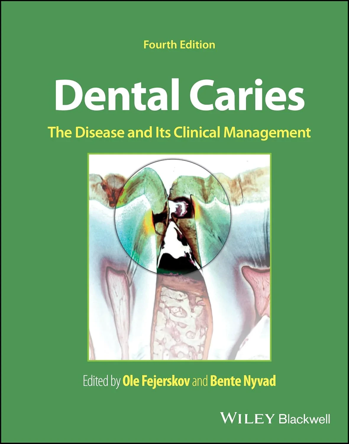 Coperta cărții "Dental Caries: The Disease and its Clinical Management " de Ole Fejerskov, Bente Nyvad