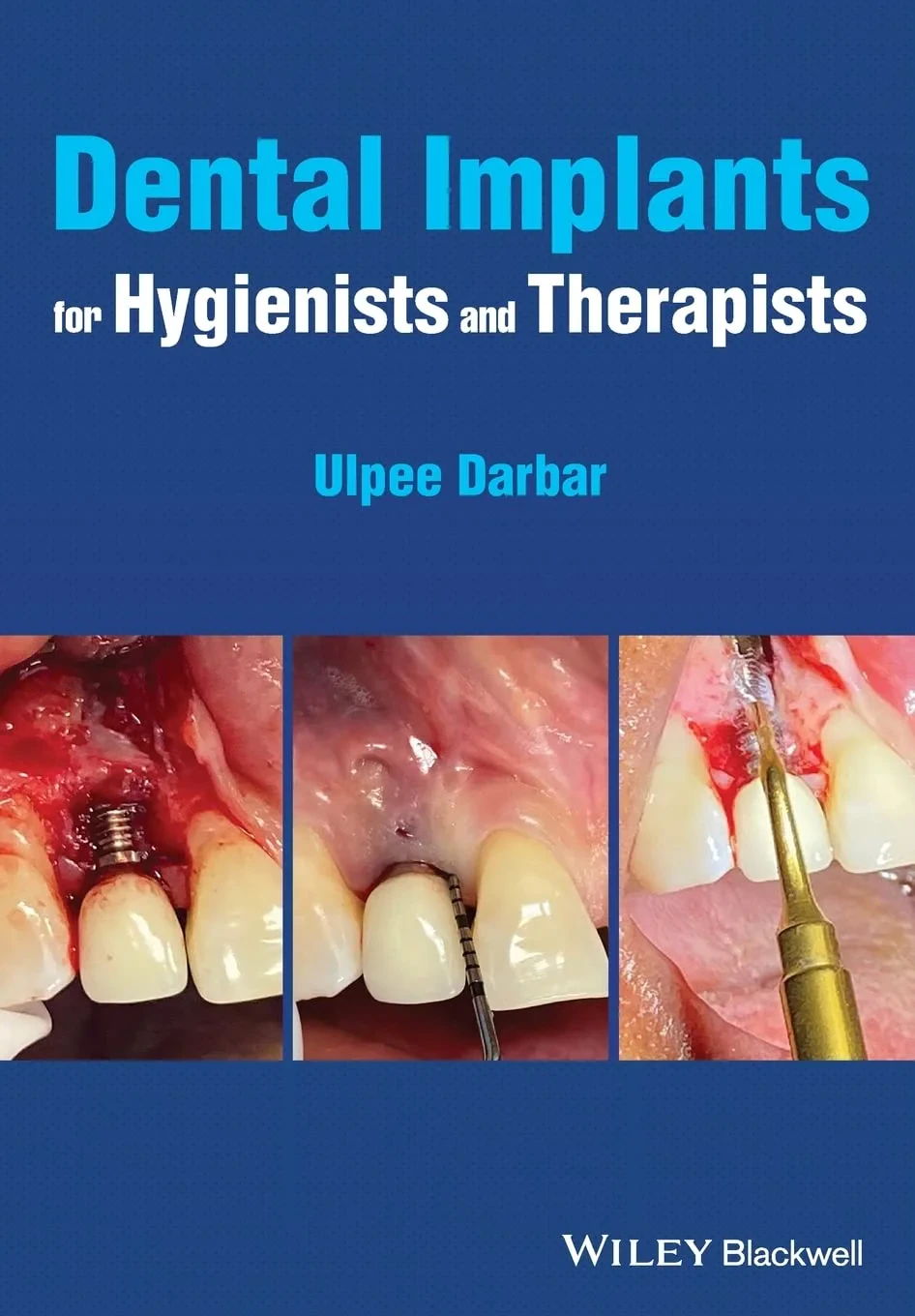 Coperta cărții "Dental Implants for Hygienists and Therapists" de U Darbar