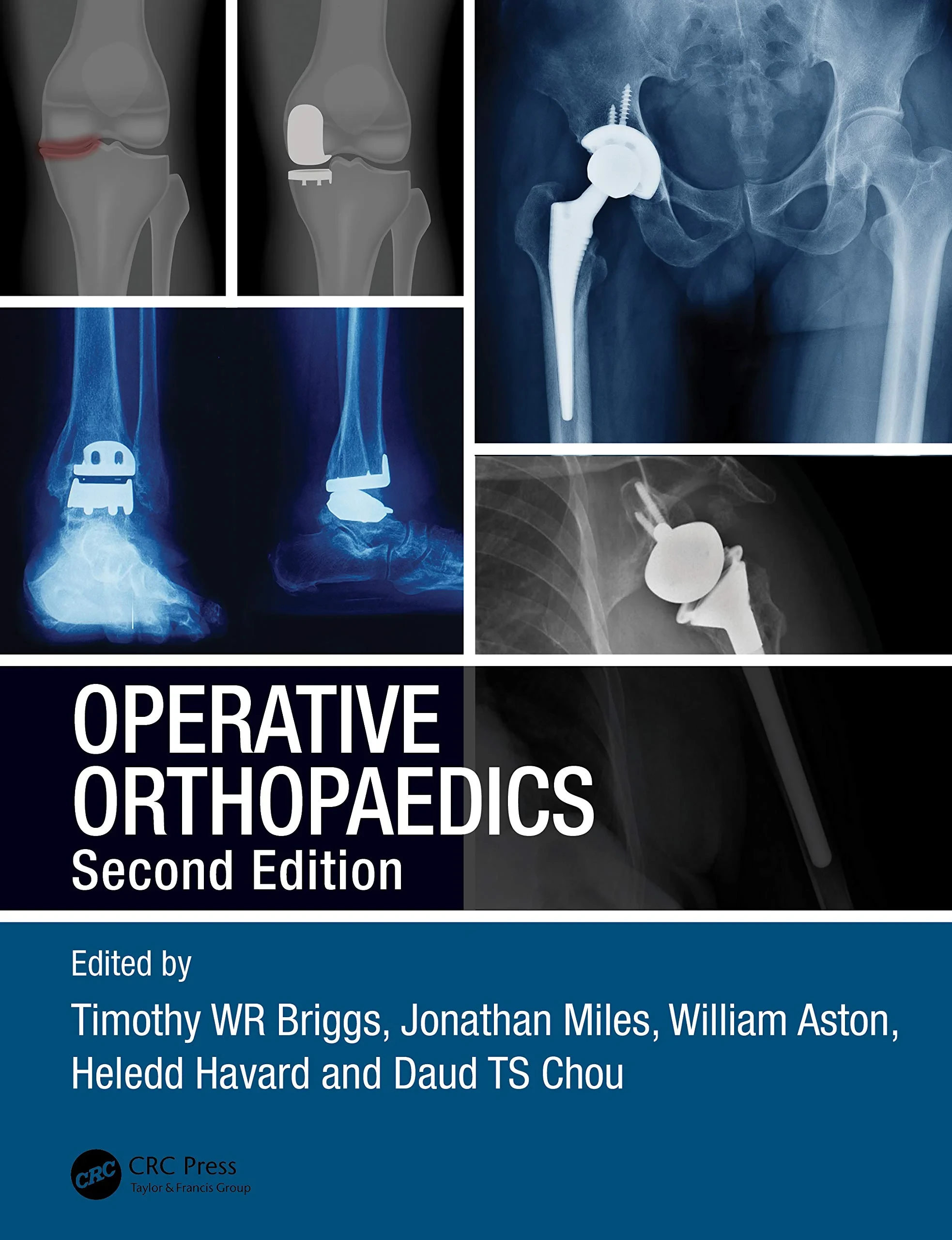 Coperta cărții "Operative Orthopaedics" de Jonathan Miles, Timothy WR Briggs, William Aston, Heledd Havard, Daud TS Chou