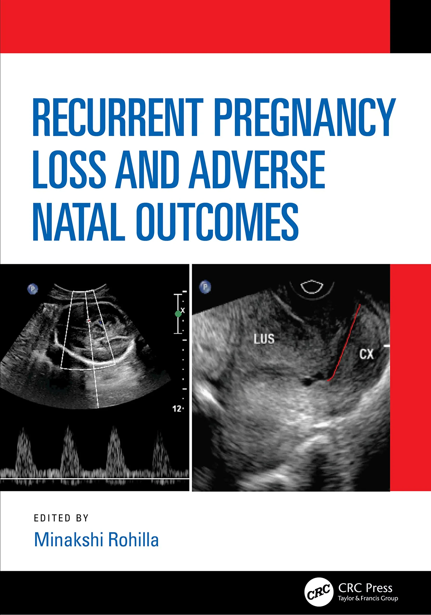 Coperta cărții "Recurrent Pregnancy Loss and Adverse Natal Outcomes" de Minakshi Rohilla