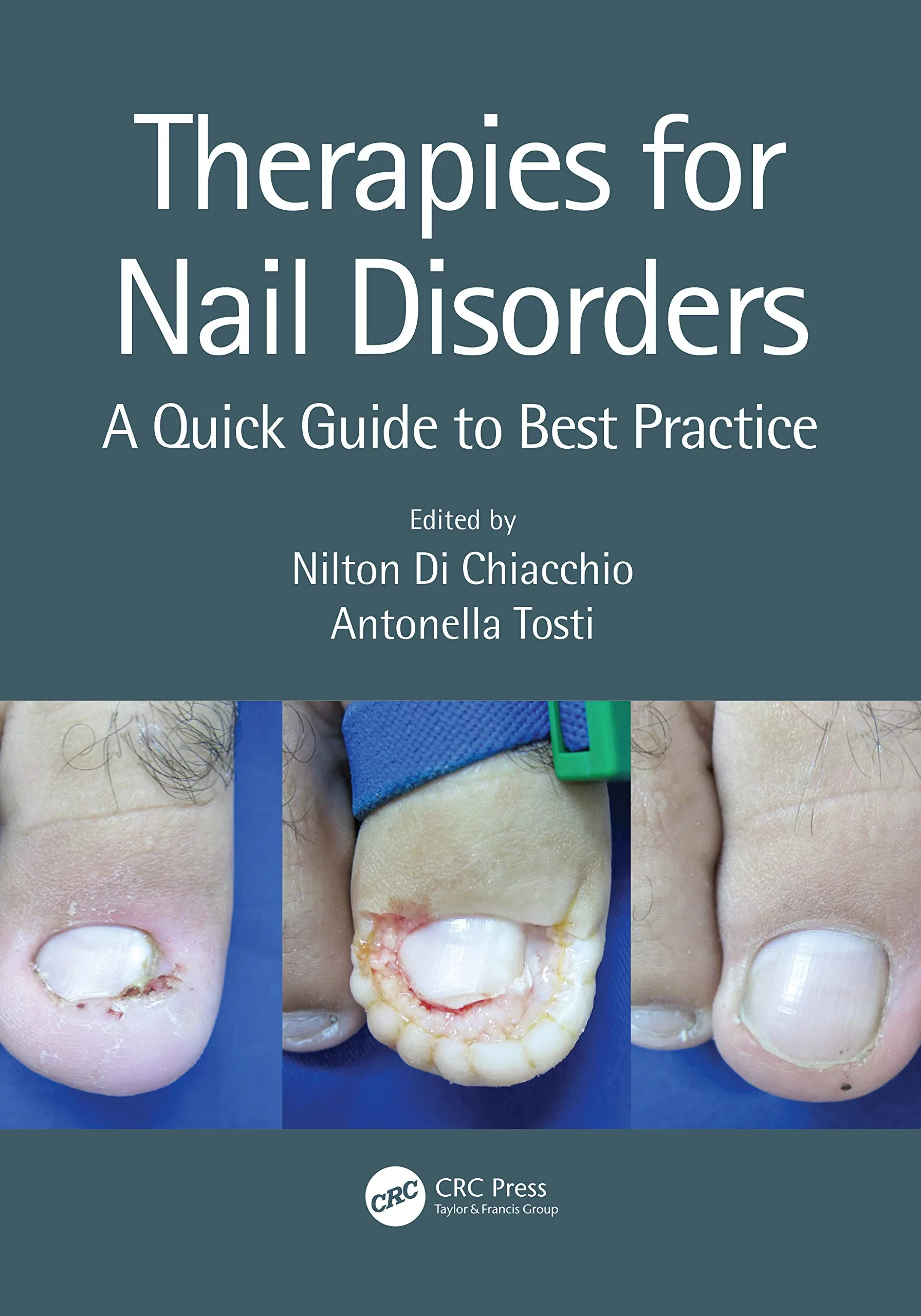Coperta cărții "Therapies for Nail Disorders: A Quick Guide to Best Practice" de Nilton Di Chiacchio, Antonella Tosti