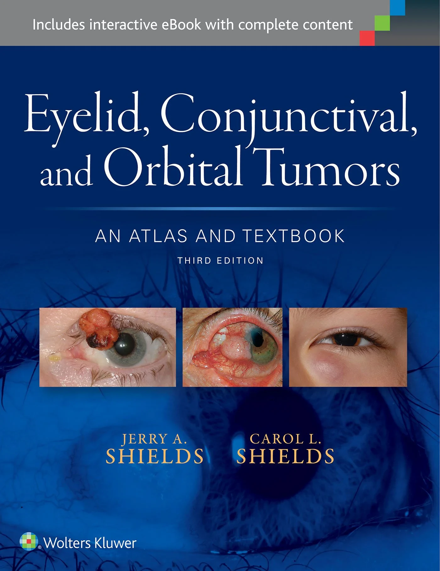 Eyelid, Conjunctival, and Orbital Tumors: An Atlas...