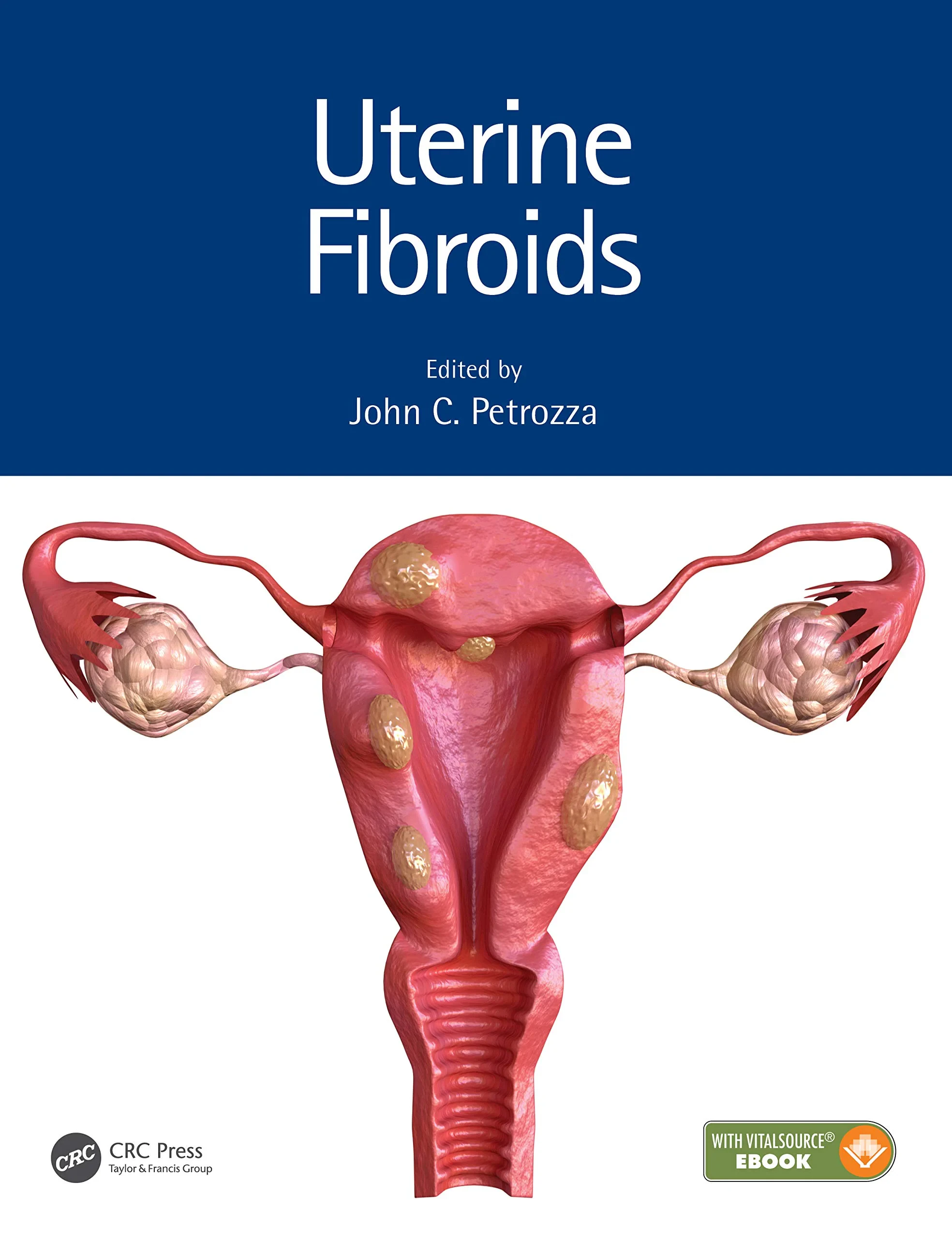 Uterine Fibroids (Reproductive Medicine and Assist...