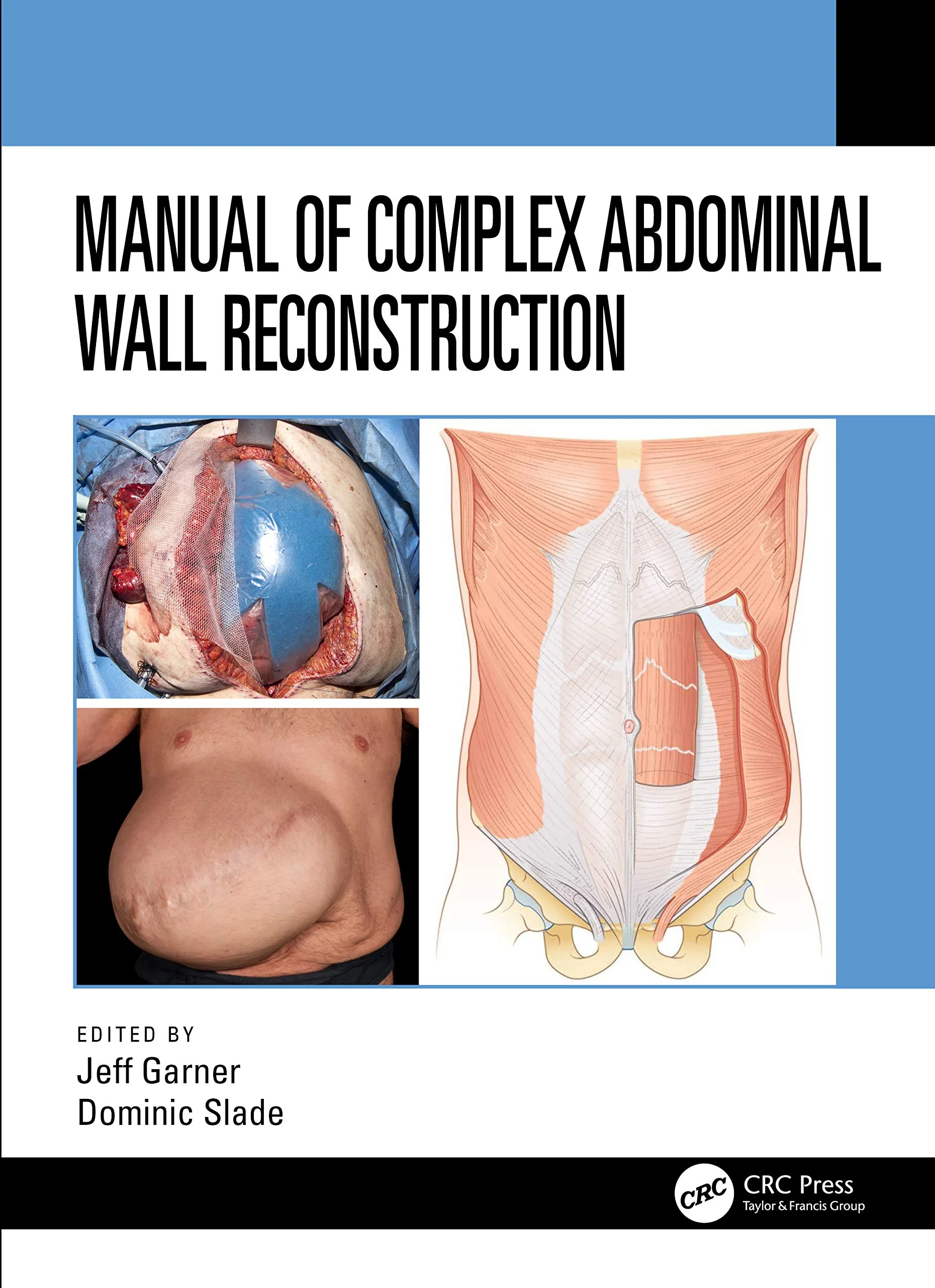 Coperta cărții "Manual of Complex Abdominal Wall Reconstruction " de Jeff Garner, Dominic Slade