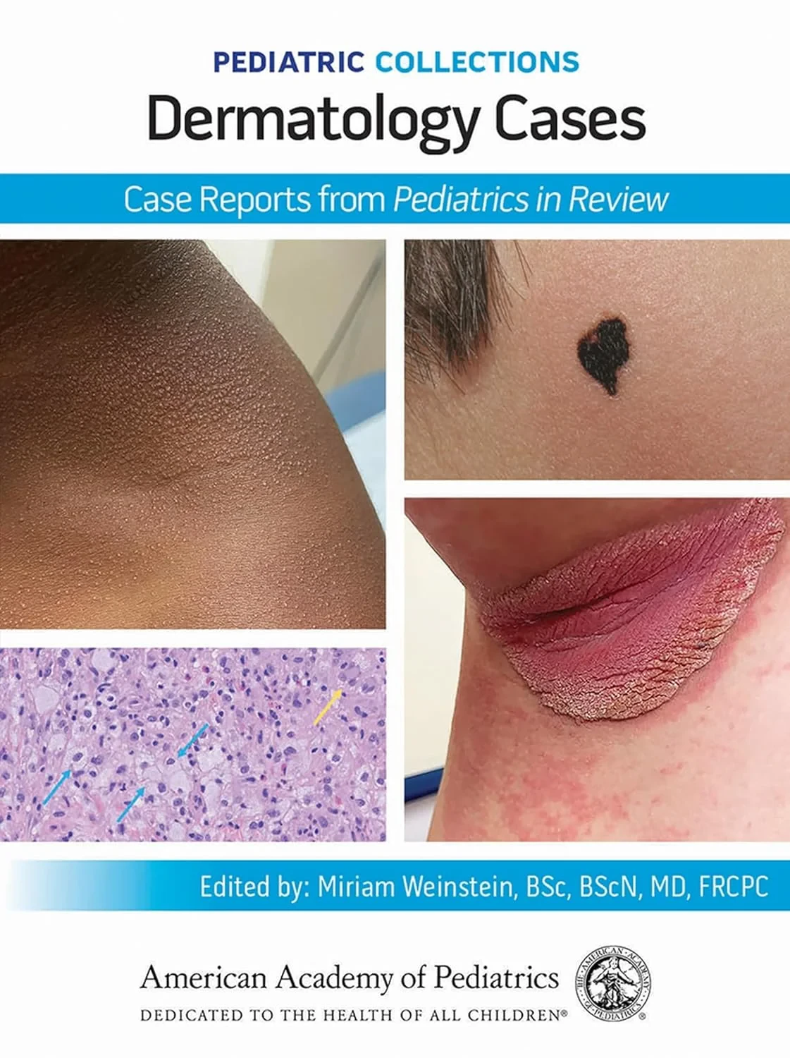 Coperta cărții "Pediatric Collections: Dermatology Cases" de MD, Miriam Weinstein B.Sc., BScN, FRCPC, Editorial Board Member, Pediatrics in Review