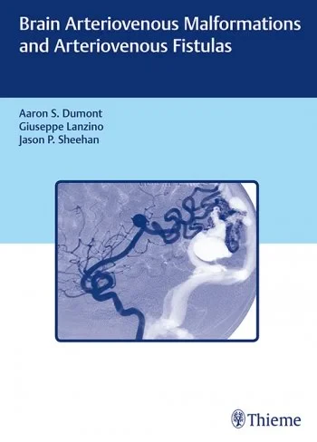 Coperta cărții "Brain Arteriovenous Malformations and Arteriovenous Fistulas" de Aaron S. Dumont, Giuseppe Lanzino