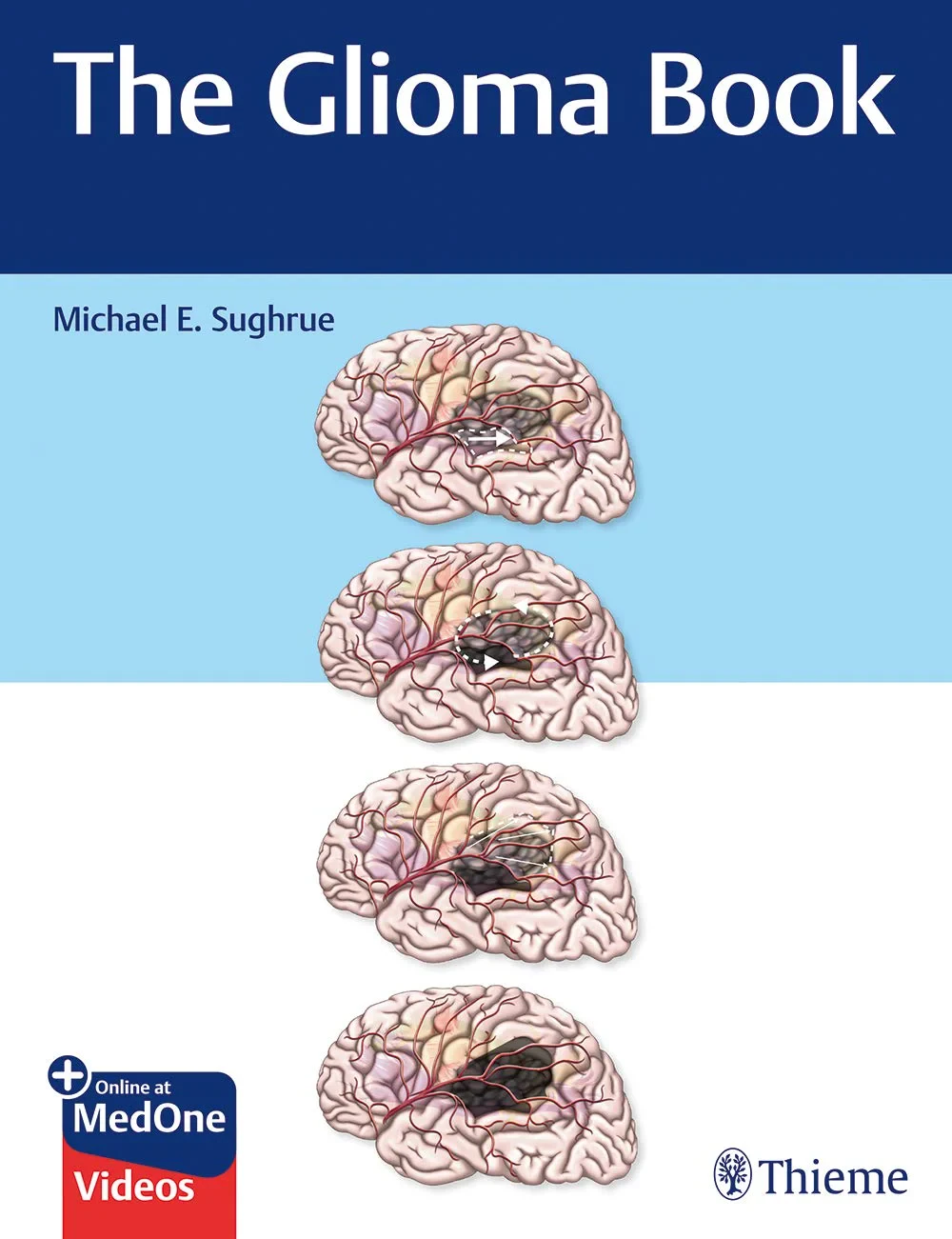 Coperta cărții "The Glioma Book " de Michael E. Sughrue