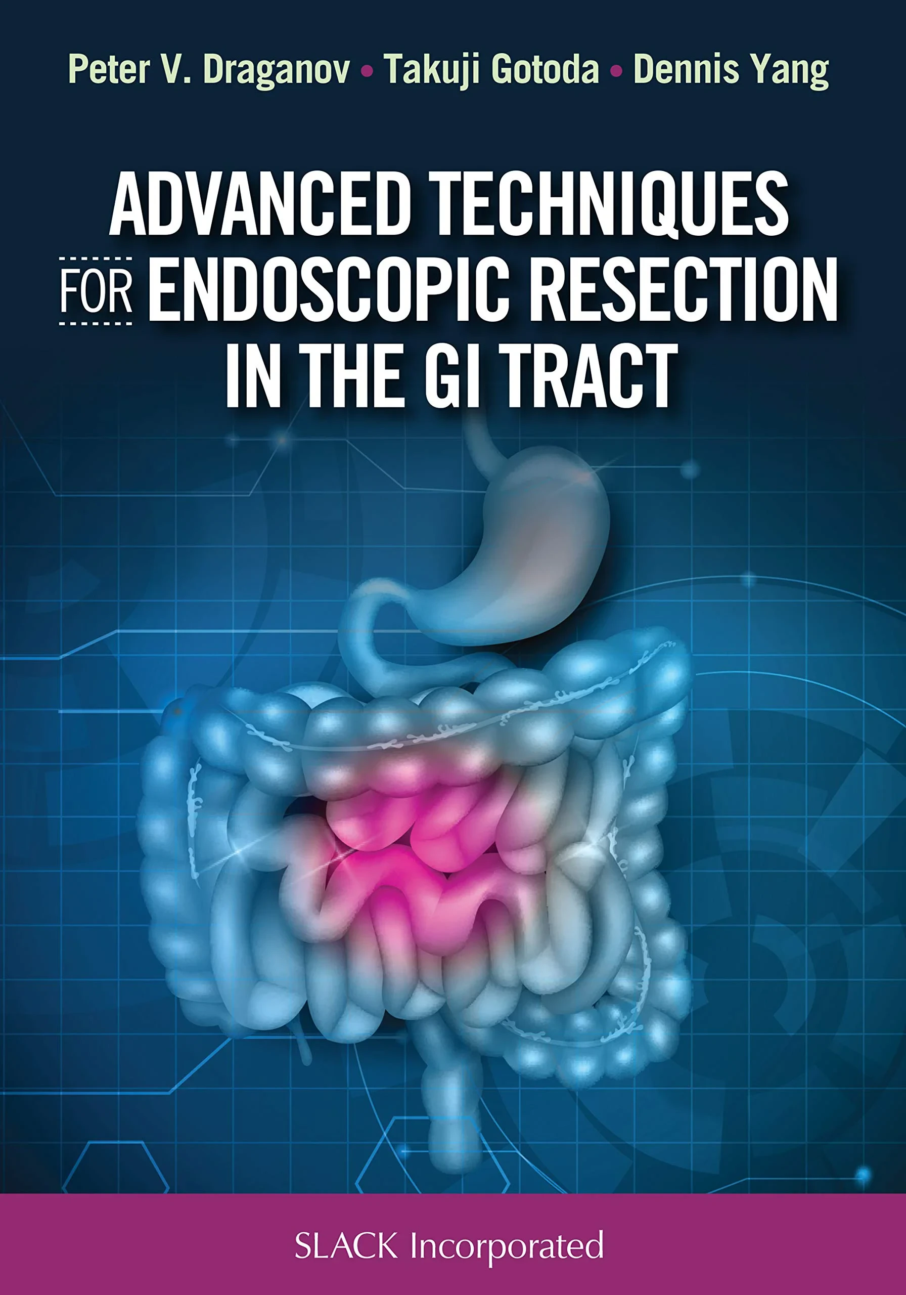 Advanced Techniques for Endoscopic Resection in th...