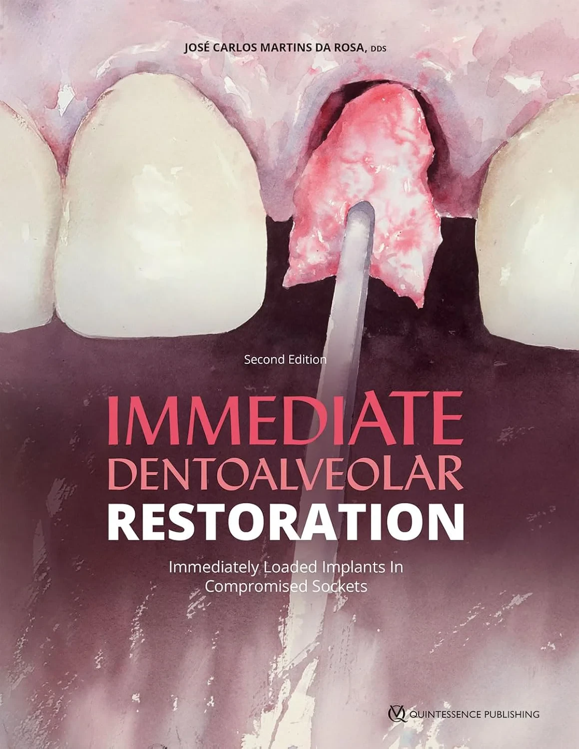 Immediate Dentoalveolar Restoration: Immediately L...
