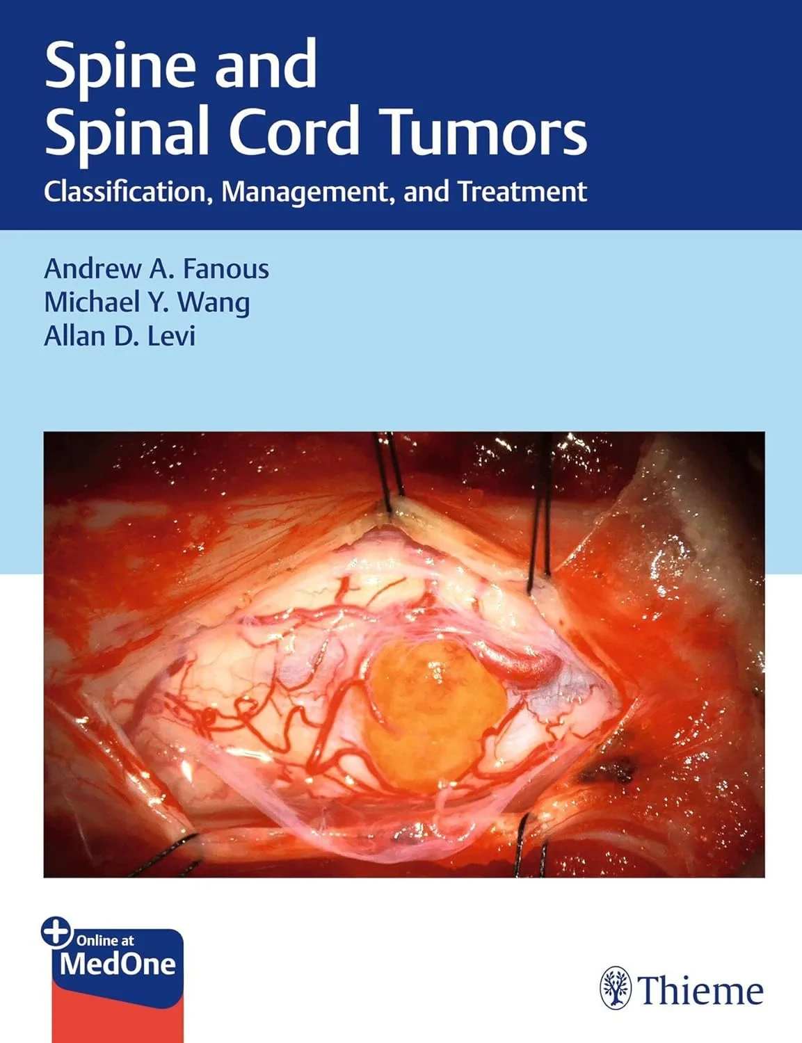 Spine and Spinal Cord Tumors. Classification, Mana...