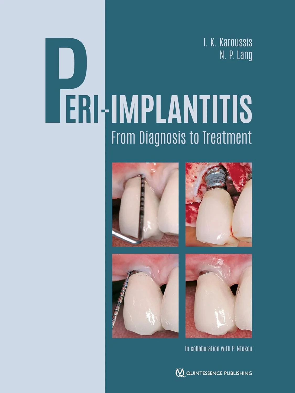 Coperta cărții "Peri-Implantitis: From Diagnosis to Treatment " de autor necunoscut