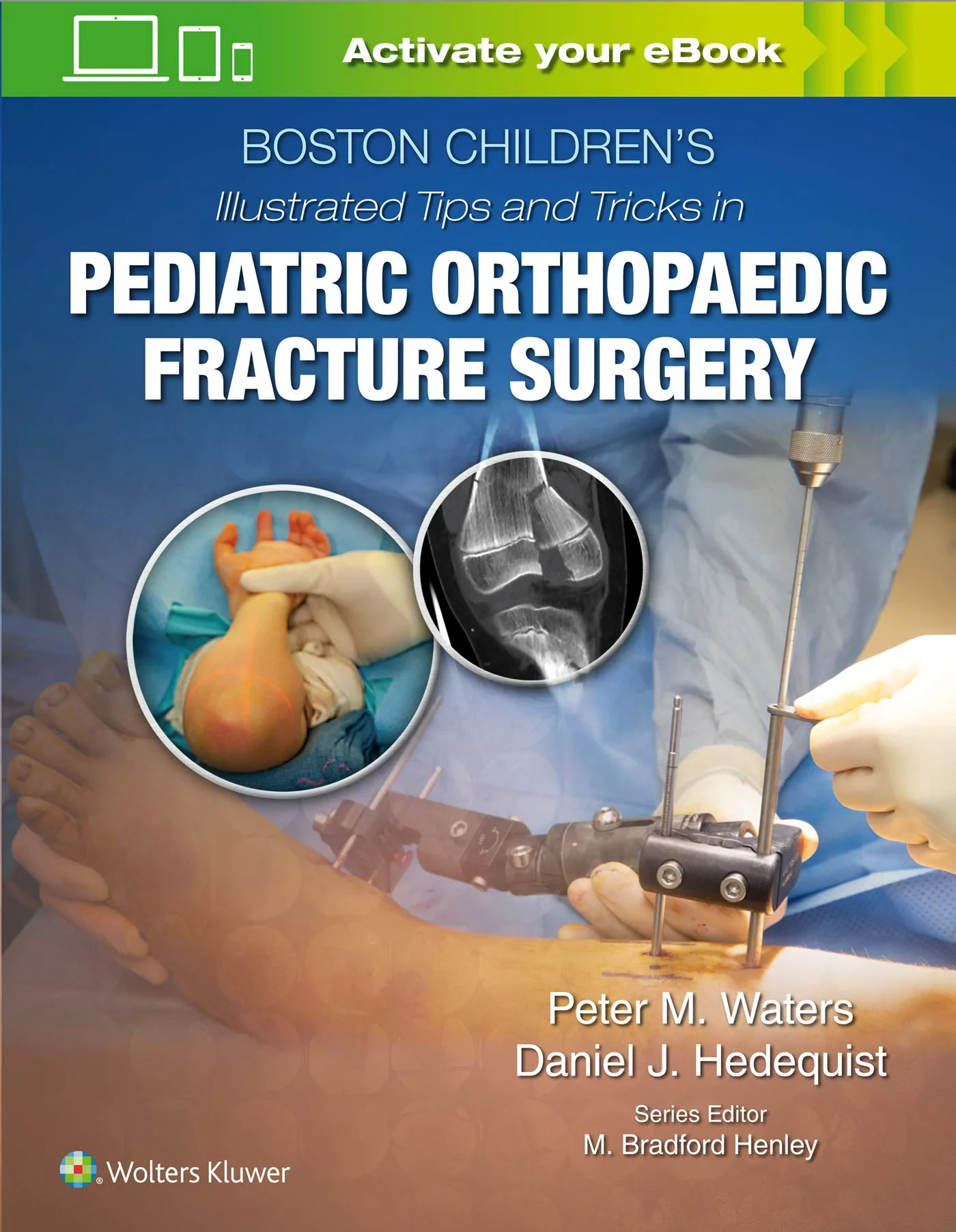 Coperta cărții "Boston Children’s Illustrated Tips and Tricks in Pediatric Orthopaedic Fracture Surgery " de Peter M Waters MD, Daniel Hedequist
