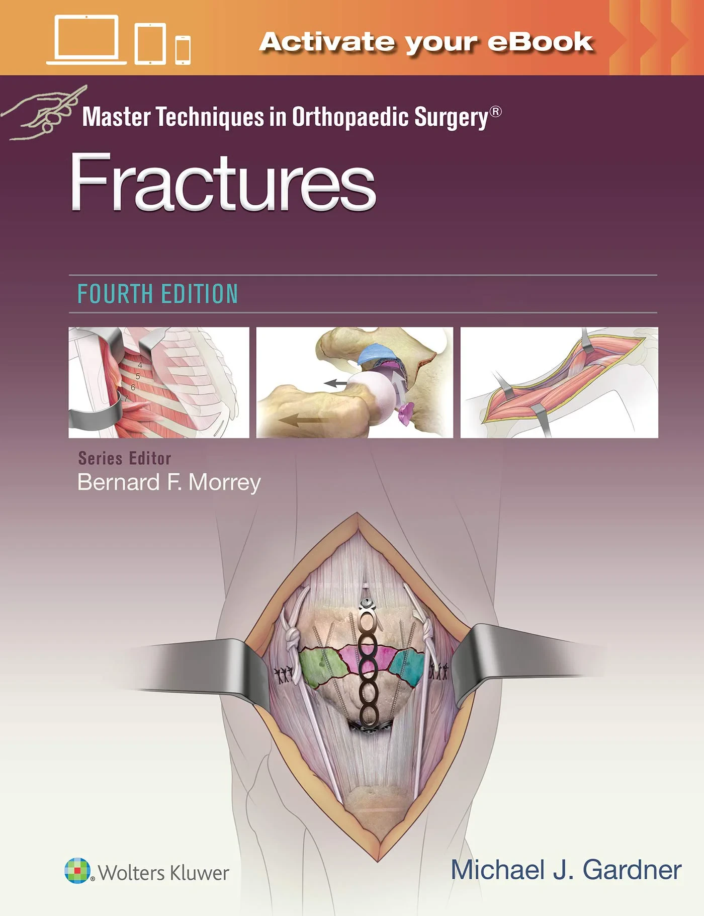 Master Techniques in Orthopaedic Surgery: Fracture...