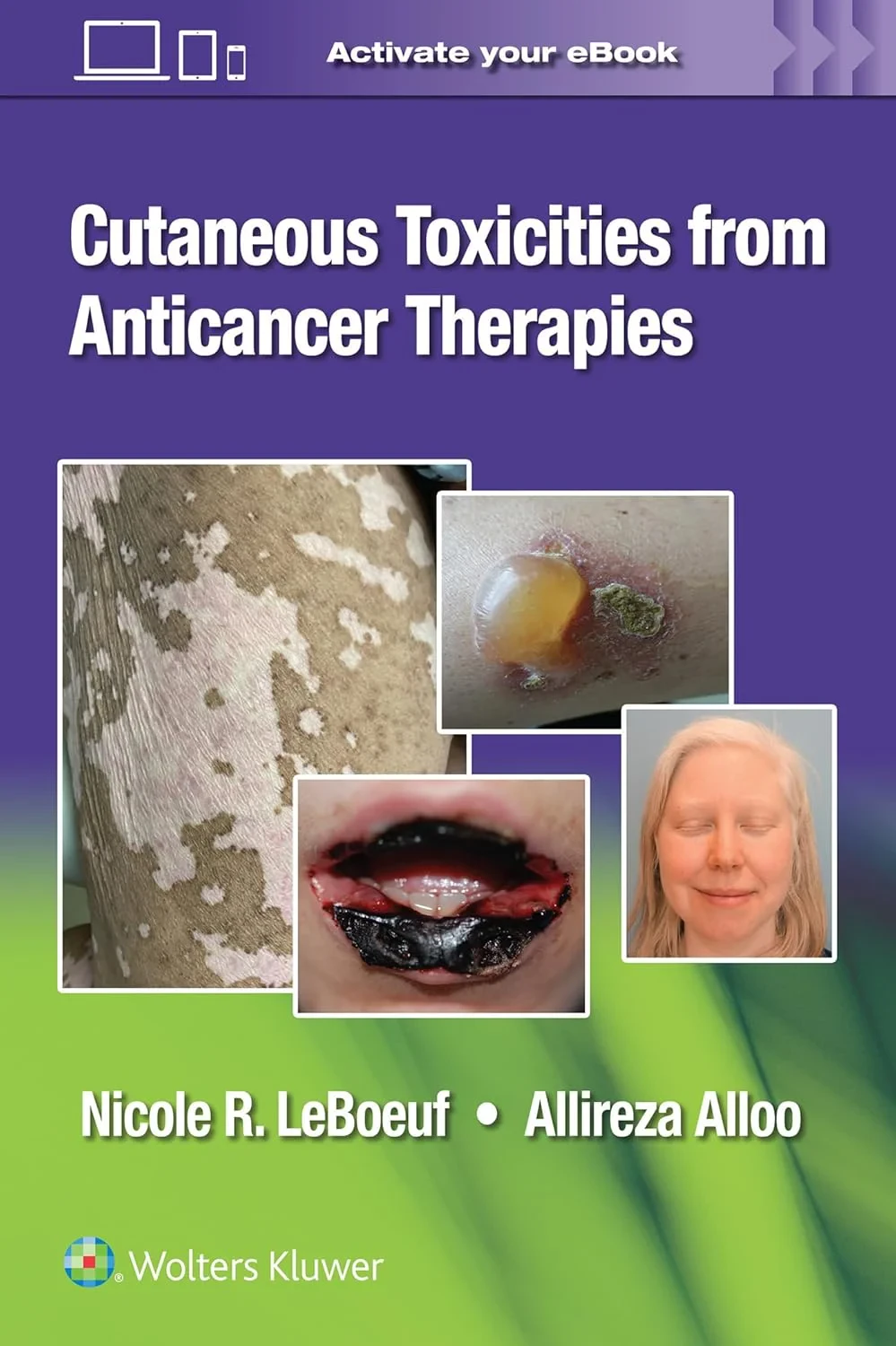 Coperta cărții "Cutaneous Reactions from Anti-Cancer Therapies" de Nicole LeBoeuf and Allireza Alloo