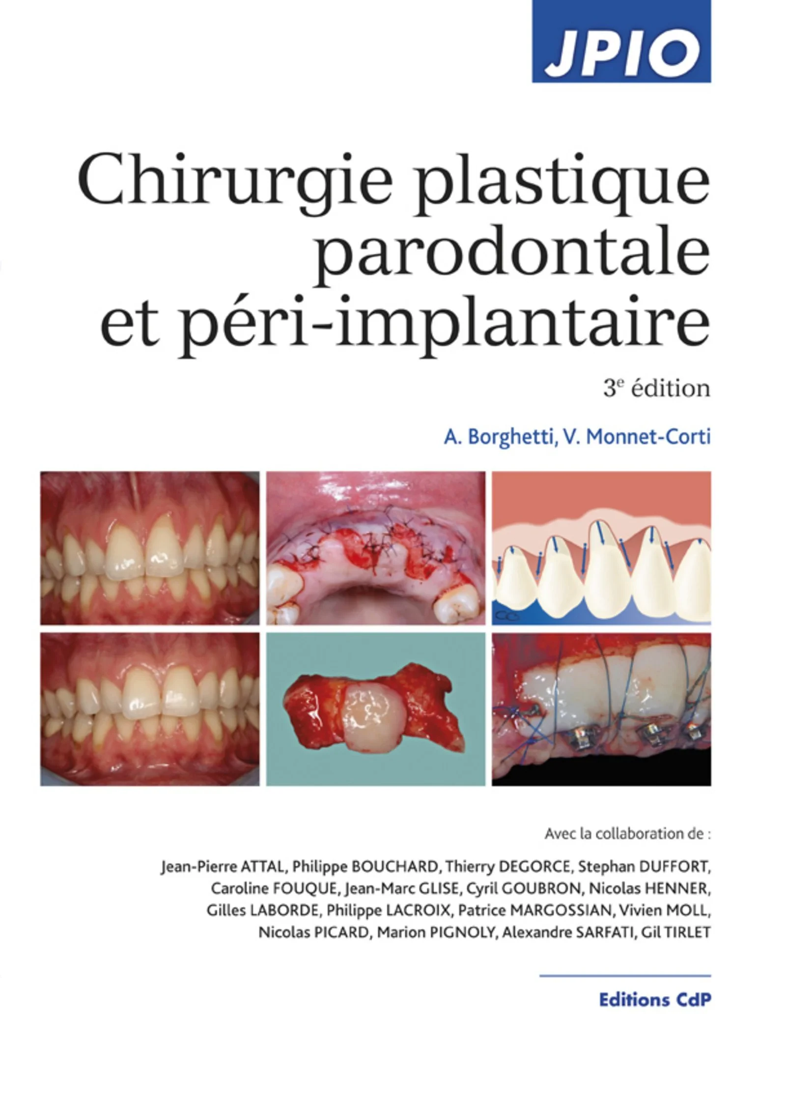 Chirurgie Plastique Parodontale Et Peri-implantair...