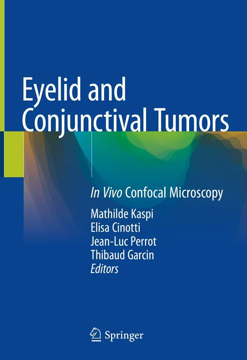 Coperta cărții "Eyelid and Conjunctival Tumors: In Vivo Confocal Microscopy" de Mathilde Kaspi, Elisa Cinotti, Jean-Luc Perrot, Thibaud Garcin