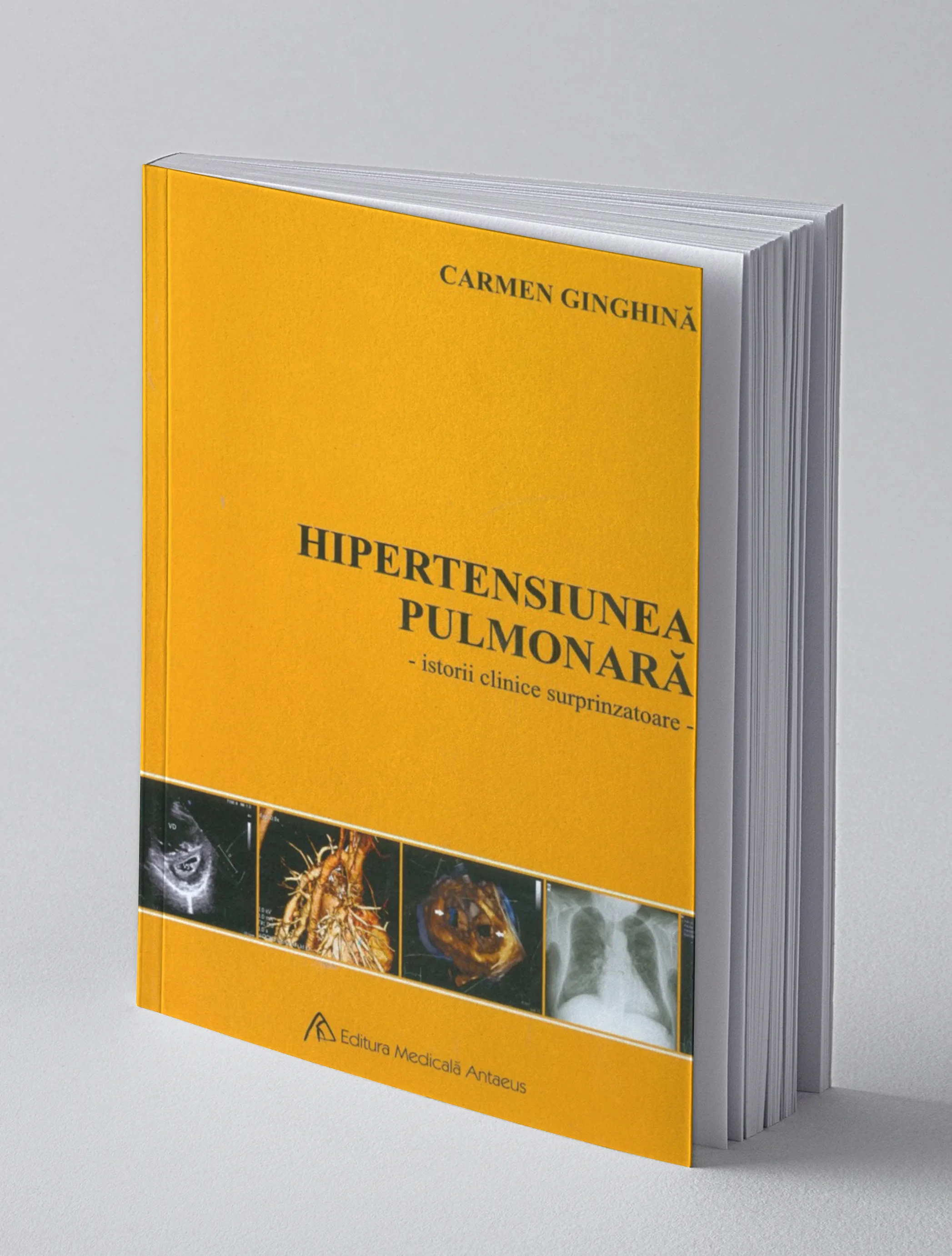 Coperta cărții "Hipertensiunea pulmonară - Istorii clinice surprinzatoare" de Carmen Ginghina
