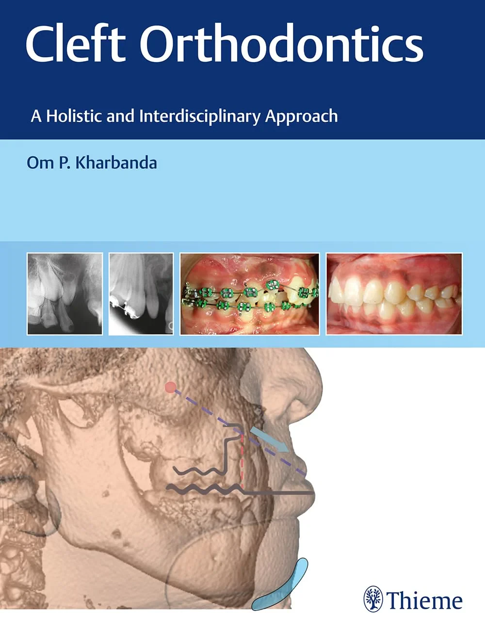 Coperta cărții "Cleft Orthodontics: A Holistic and Interdisciplinary Approach" de Om P. Kharbanda