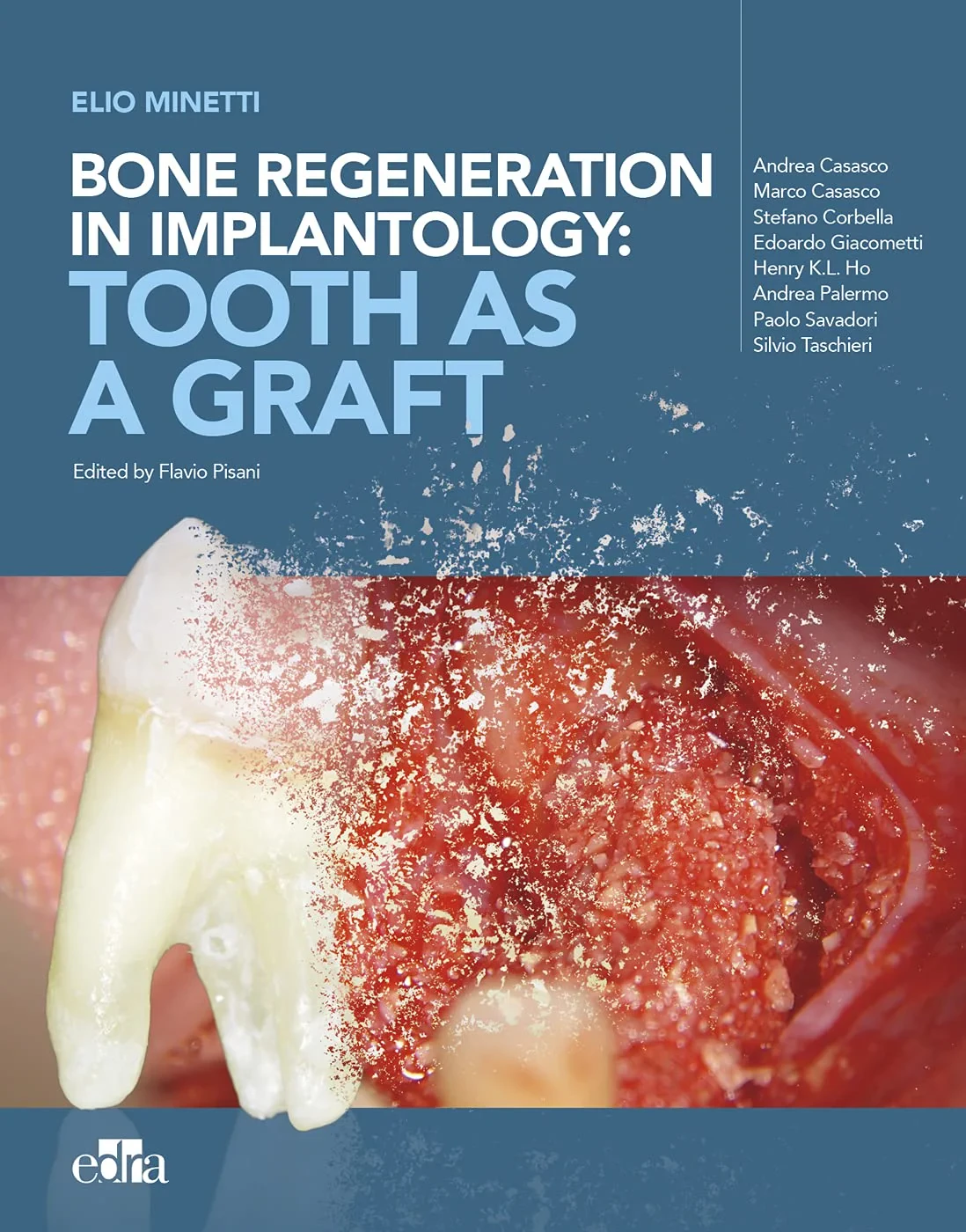 Coperta cărții "Bone regeneration in implantology: tooth as a graft" de Elio Minetti Flavio Pisani