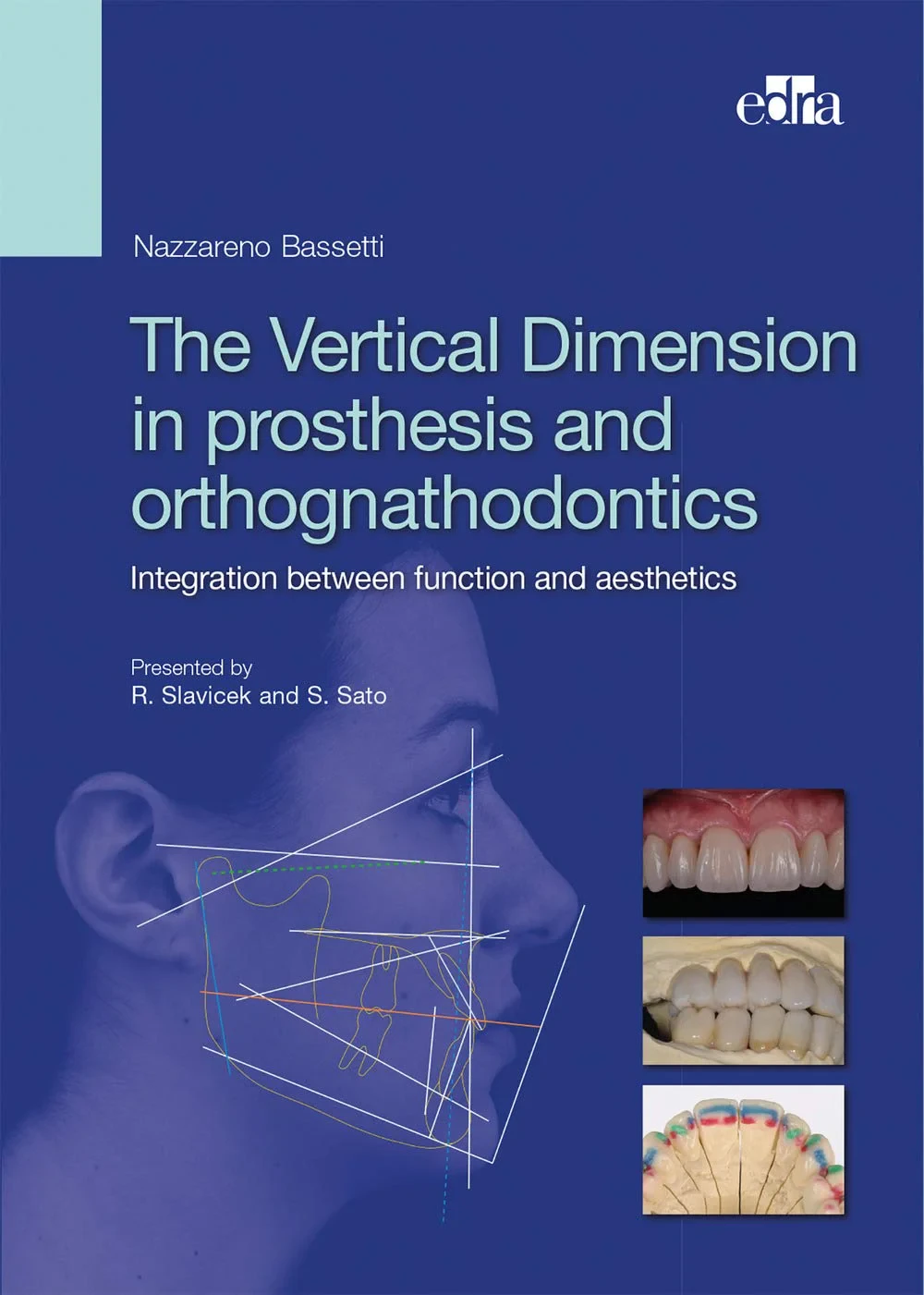 Coperta cărții "The Vertical Dimension in Prosthetis and Orthognathodontics" de Nazzareno Bassetti